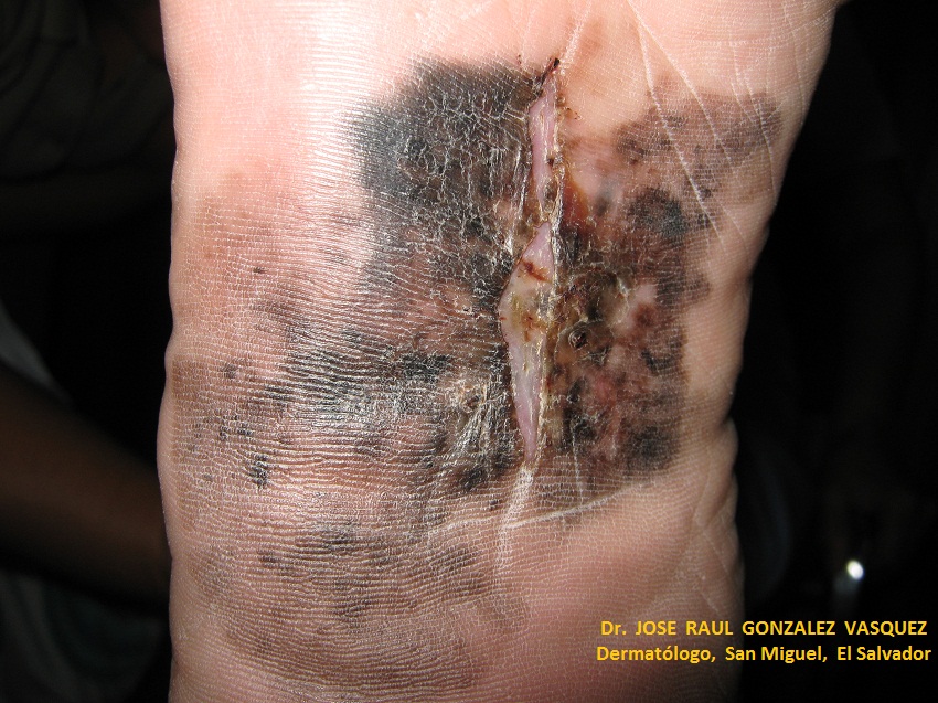 MELANOMA MALIGNO Acral pie derecho