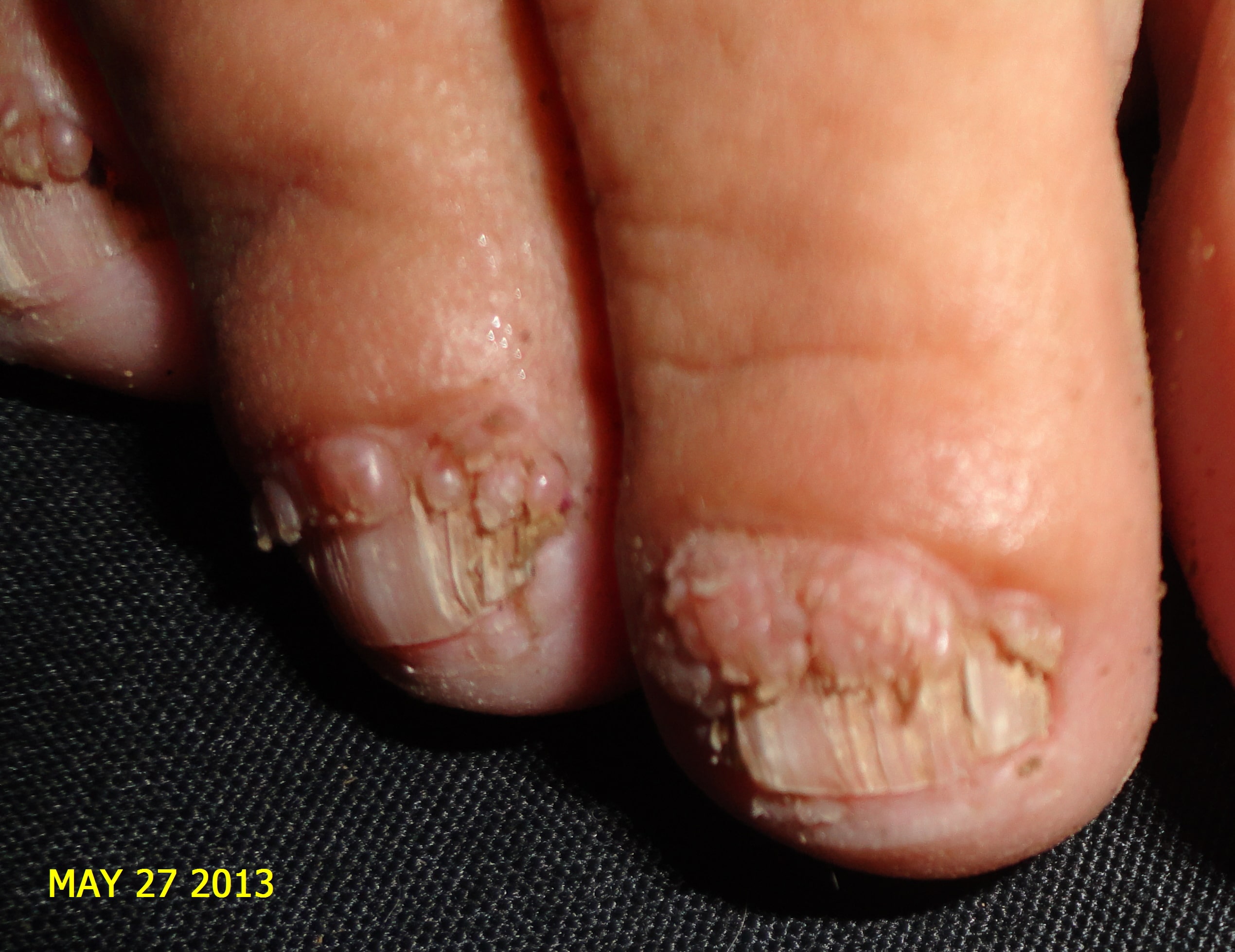 ESCLEROSIS TUBEROSA - Tumor de Koebner