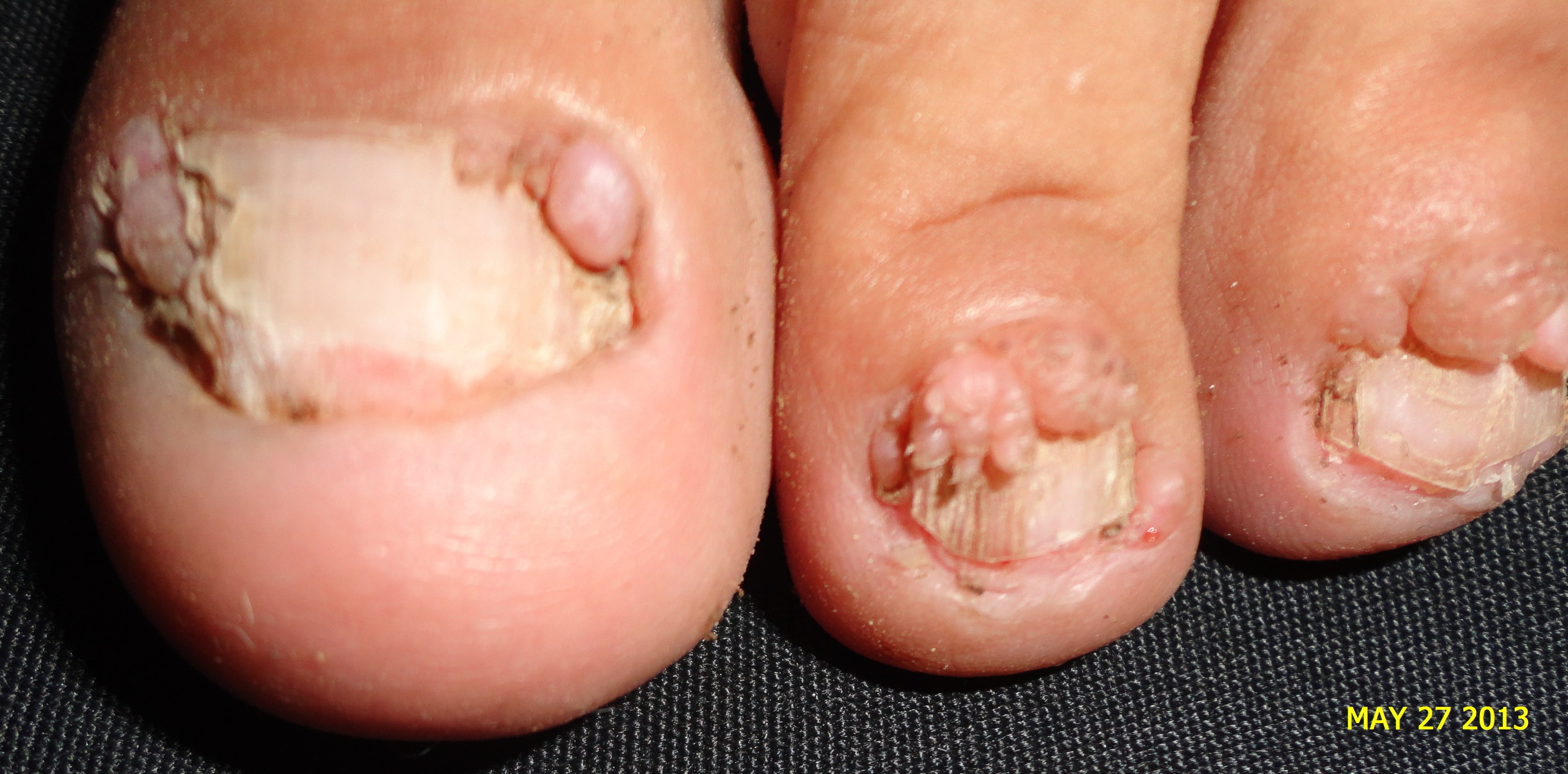 ESCLEROSIS TUBEROSA - Tumor de Koebner