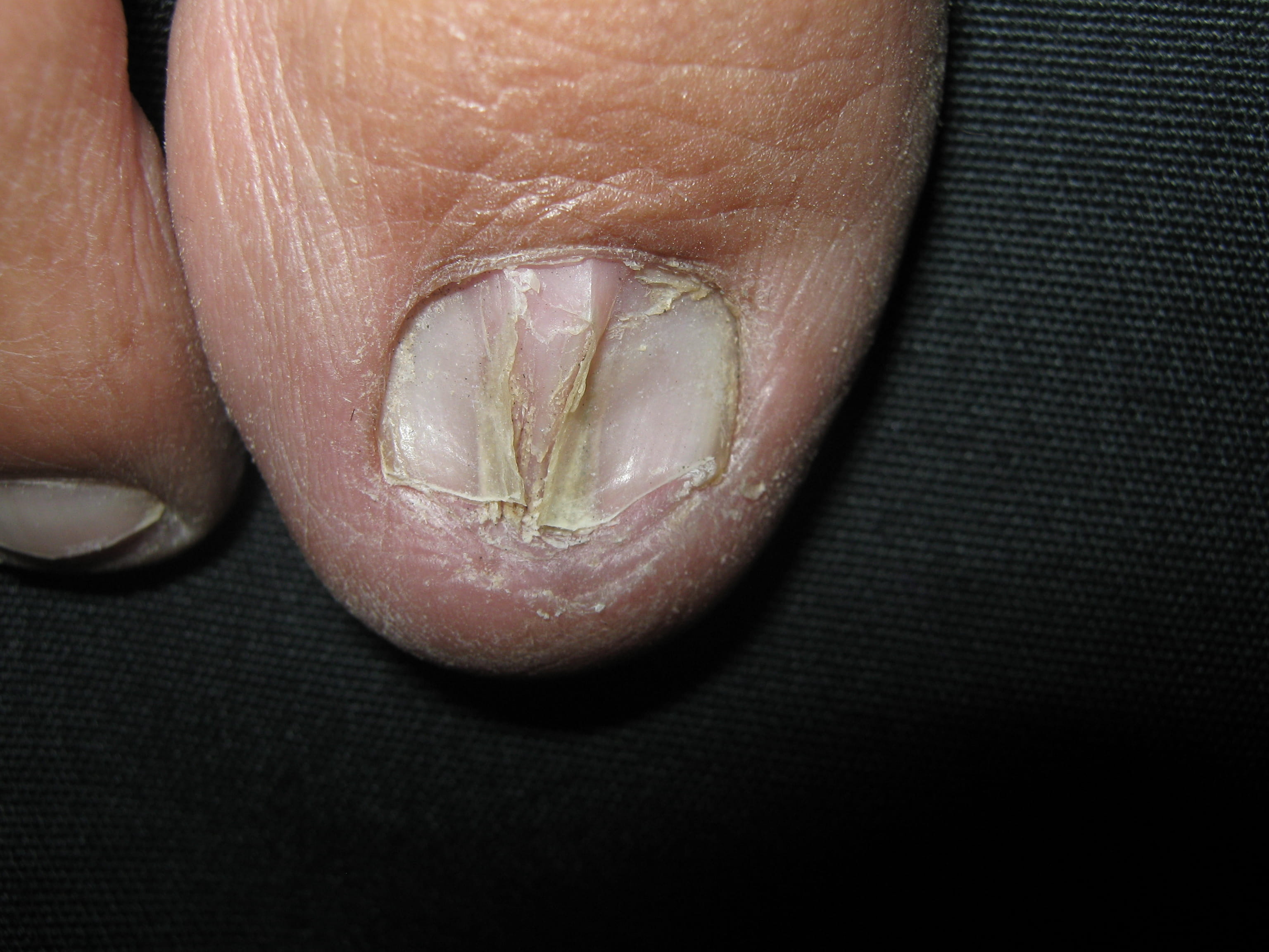 PTERIGION UNGEUAL VENTRAL