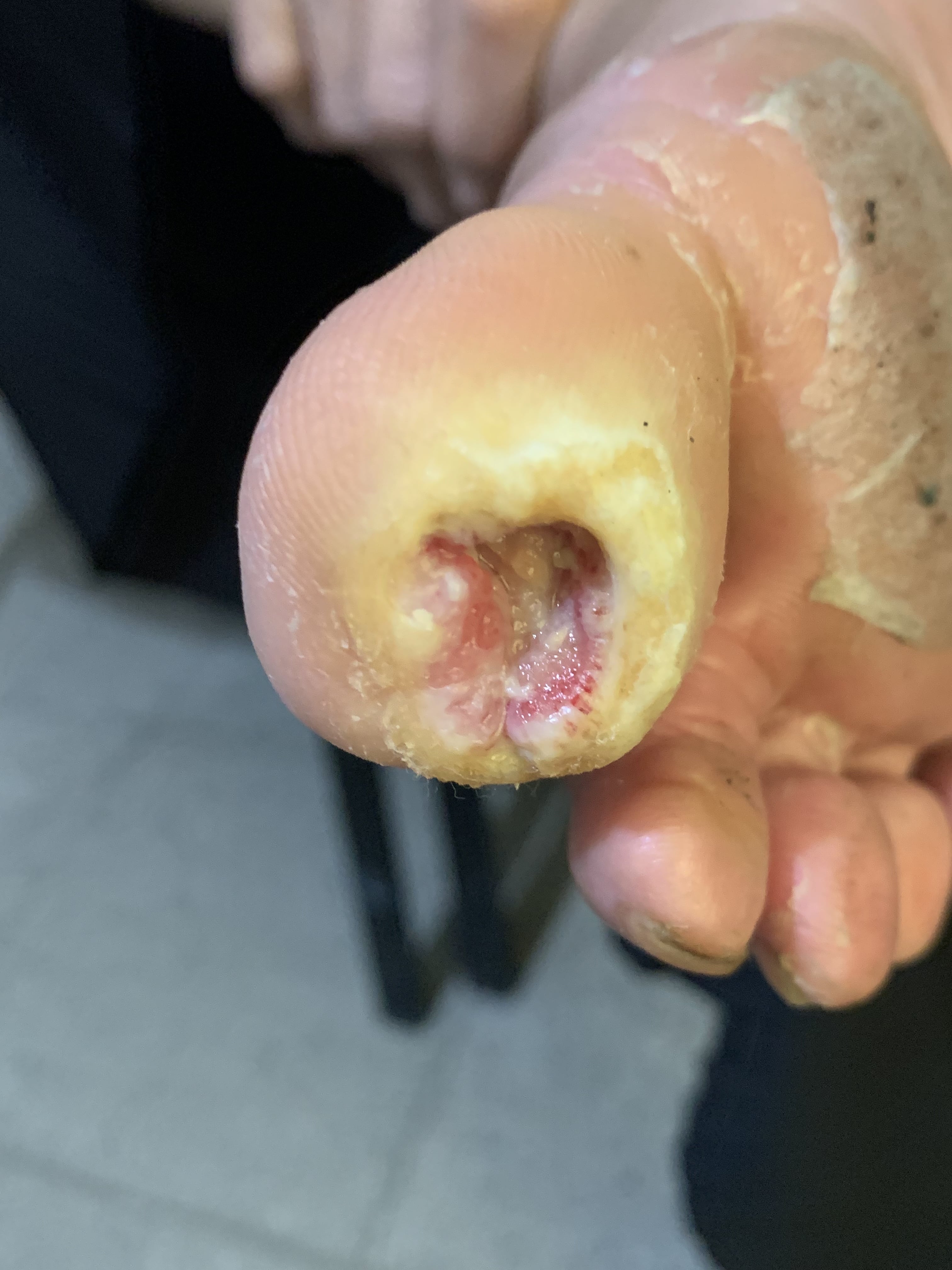 DIABETES MELLITUS y Ulcera pie diabético