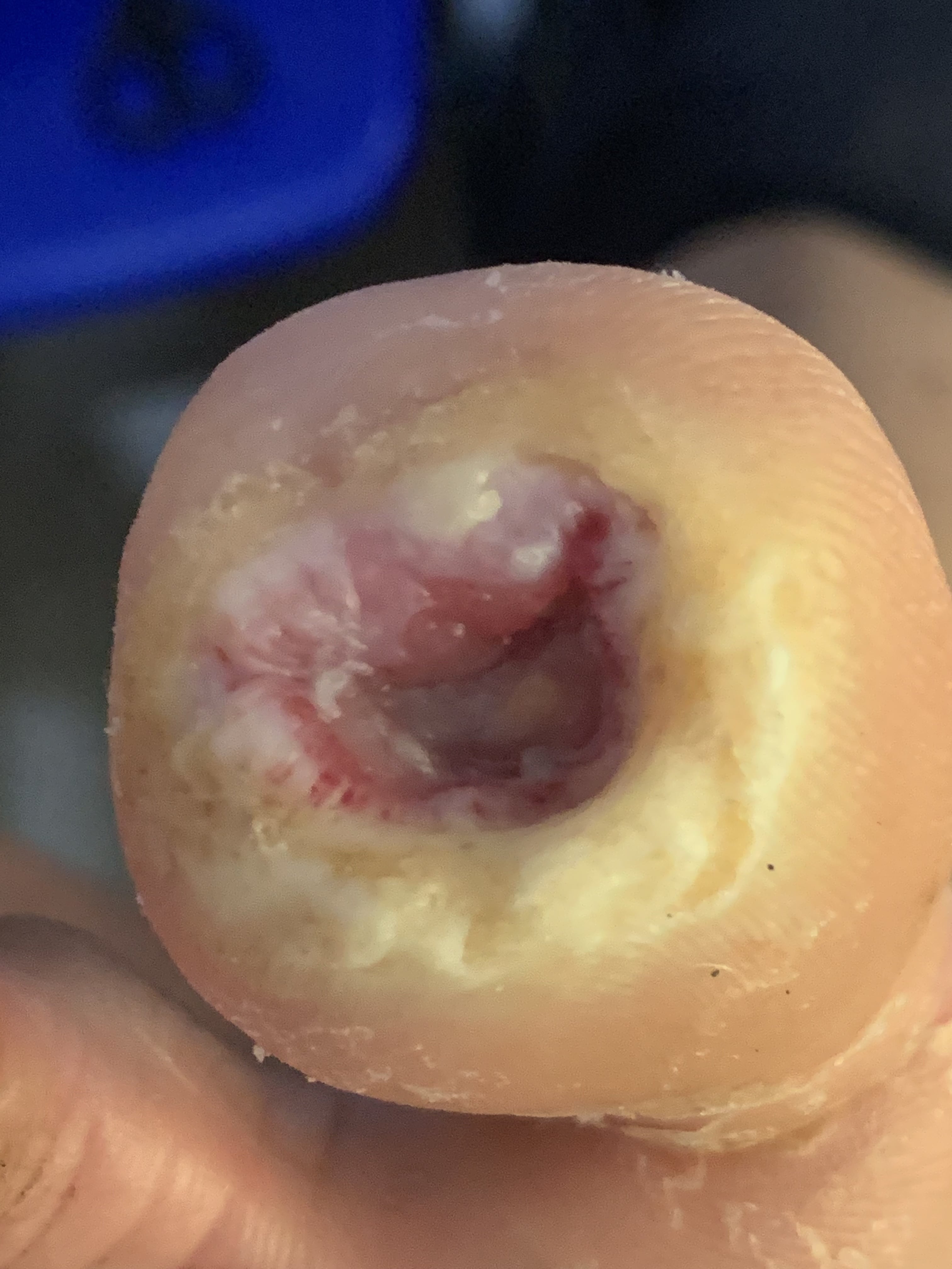 DIABETES MELLITUS y Ulcera pie diabético