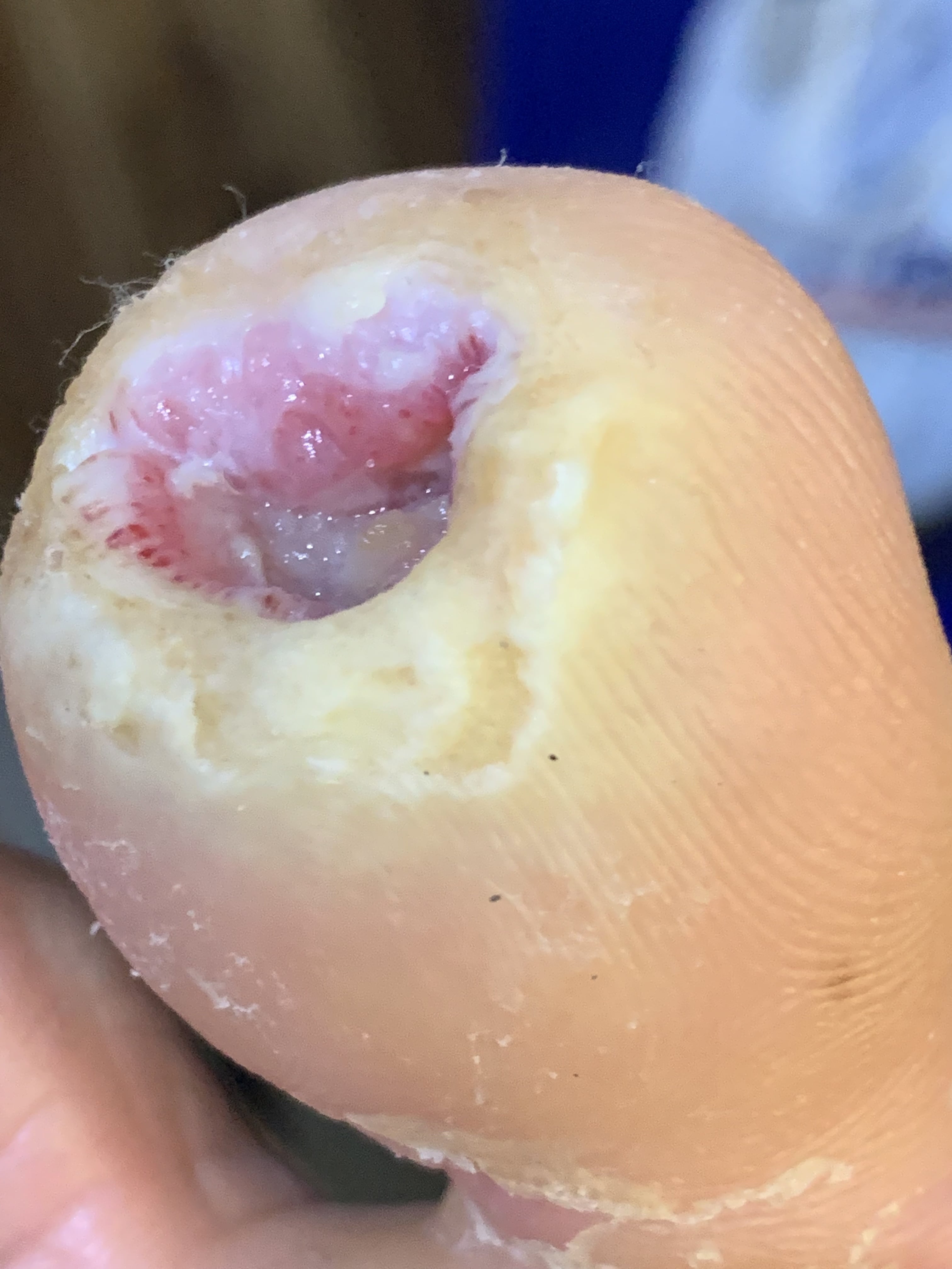 DIABETES MELLITUS y Ulcera pie diabético