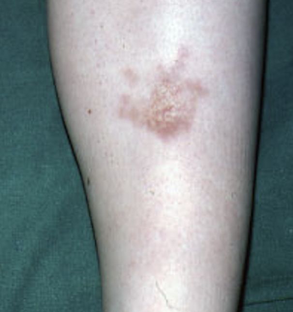 NECROBIOSIS LIPOIDICA