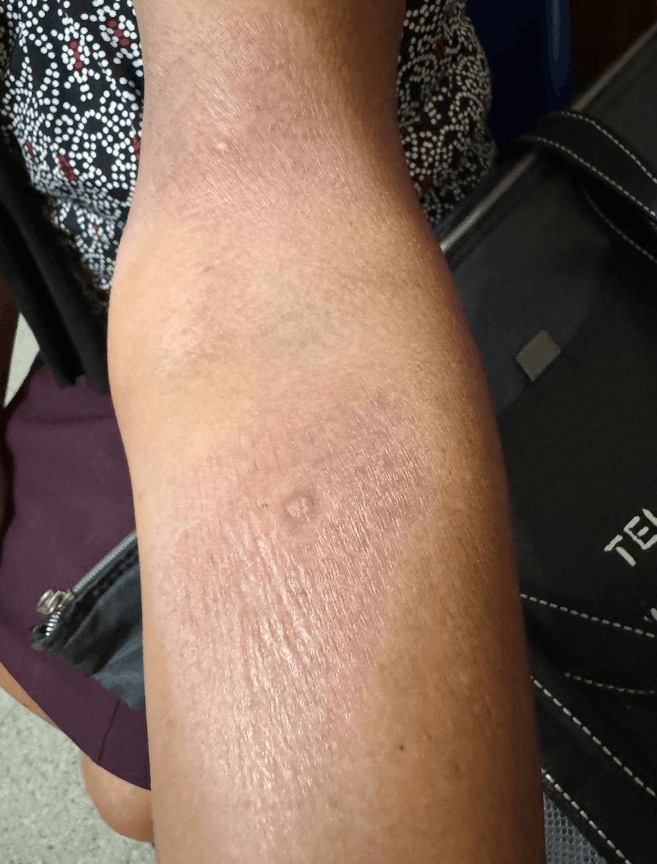 CICATRIZ ATROFICA - Esclerodermia en placas