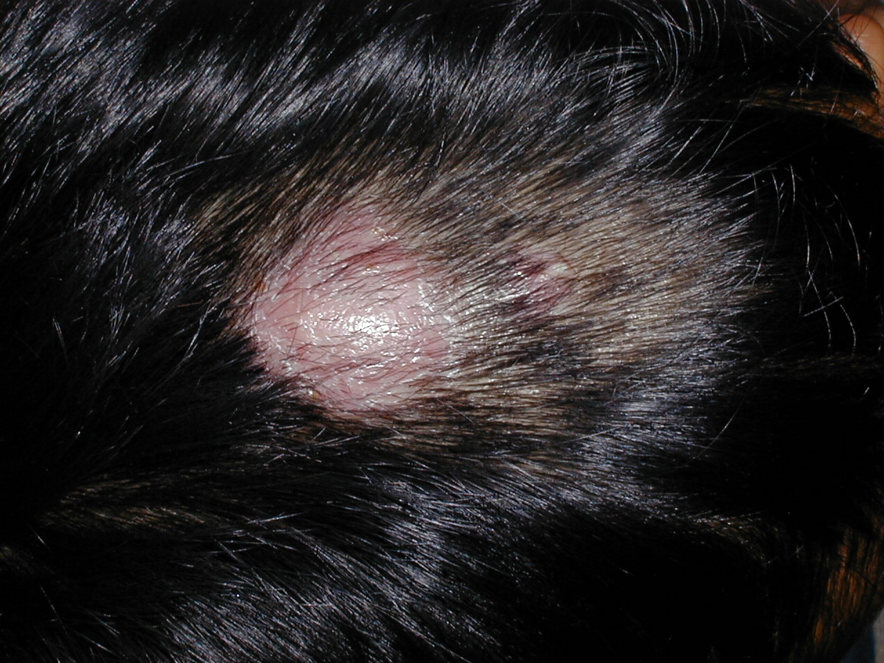 TIÑA INFLAMATORIA DE LA CABEZA