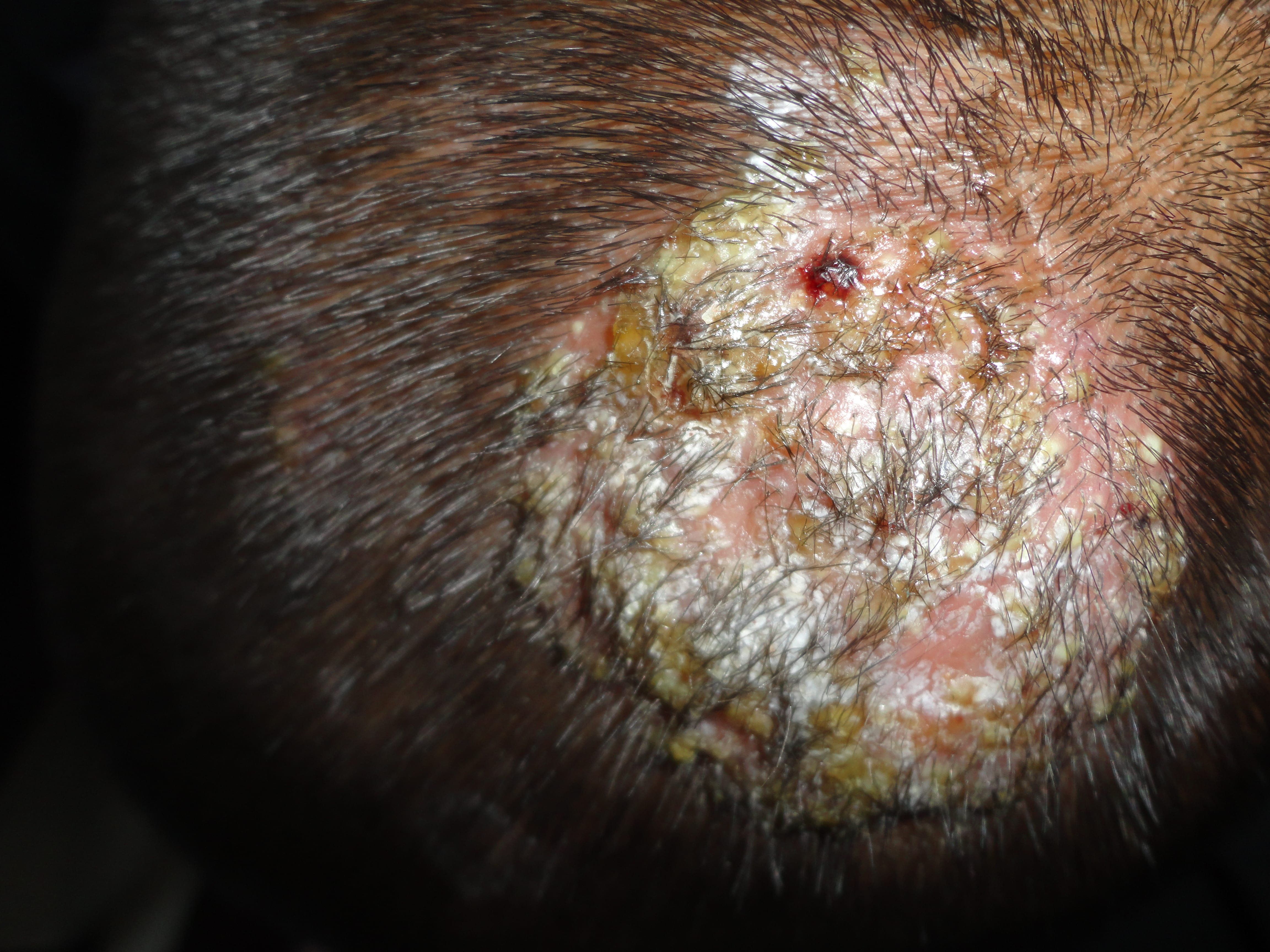 TIÑA INFLAMATORIA DE LA CABEZA