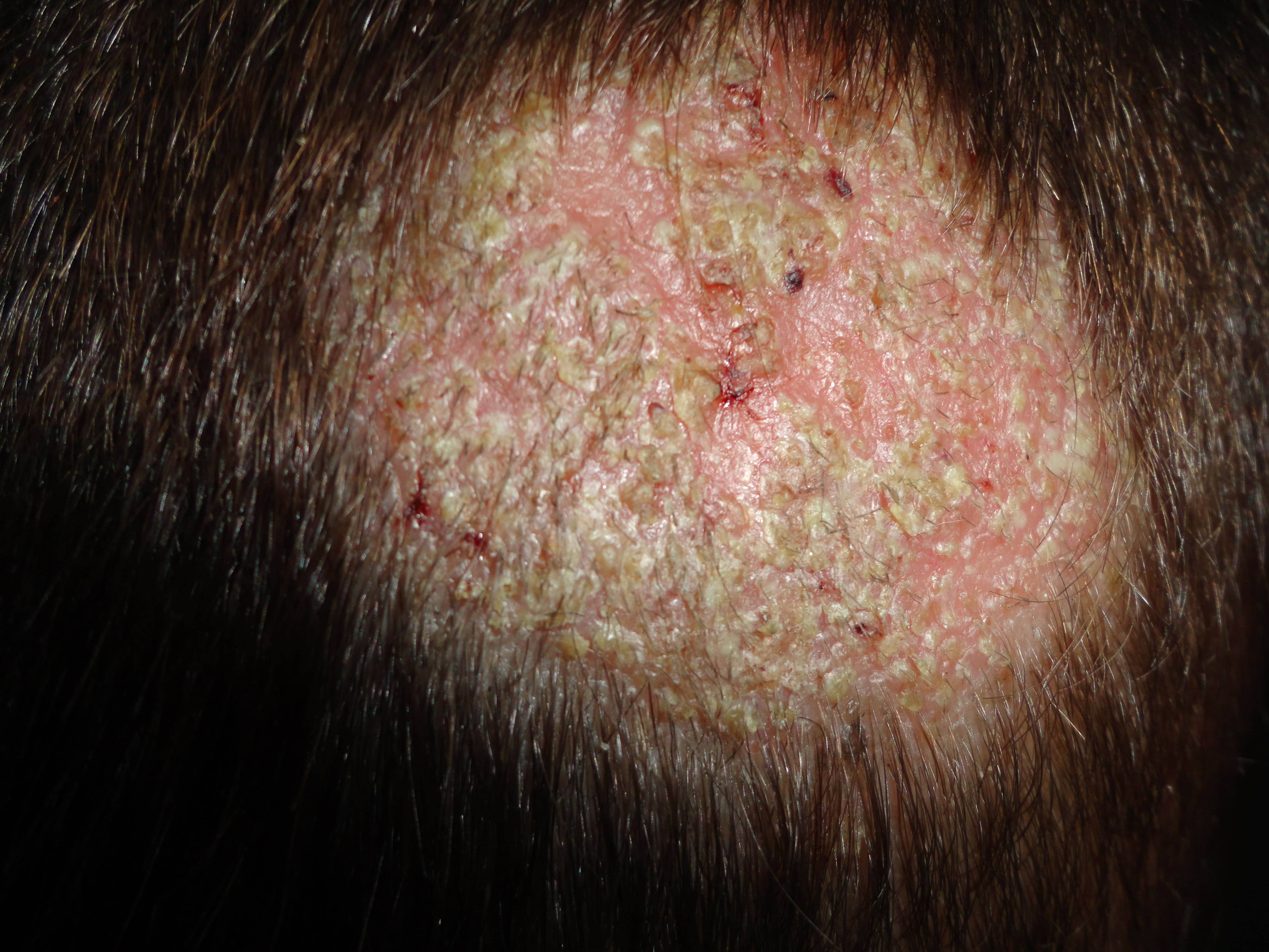 TIÑA INFLAMATORIA DE LA CABEZA