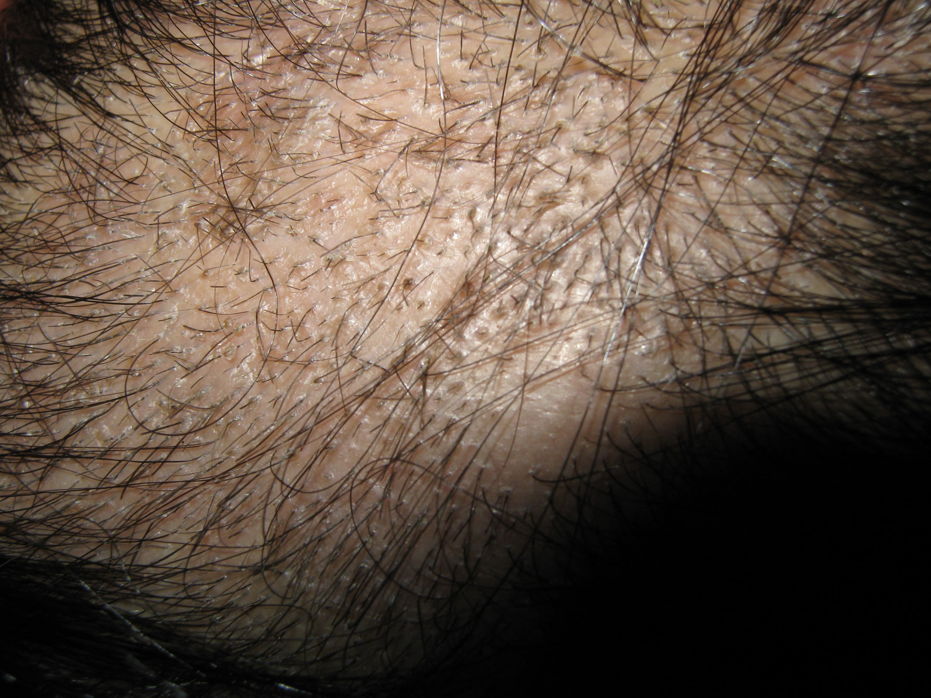 TIÑA SECA DE LA CABEZA