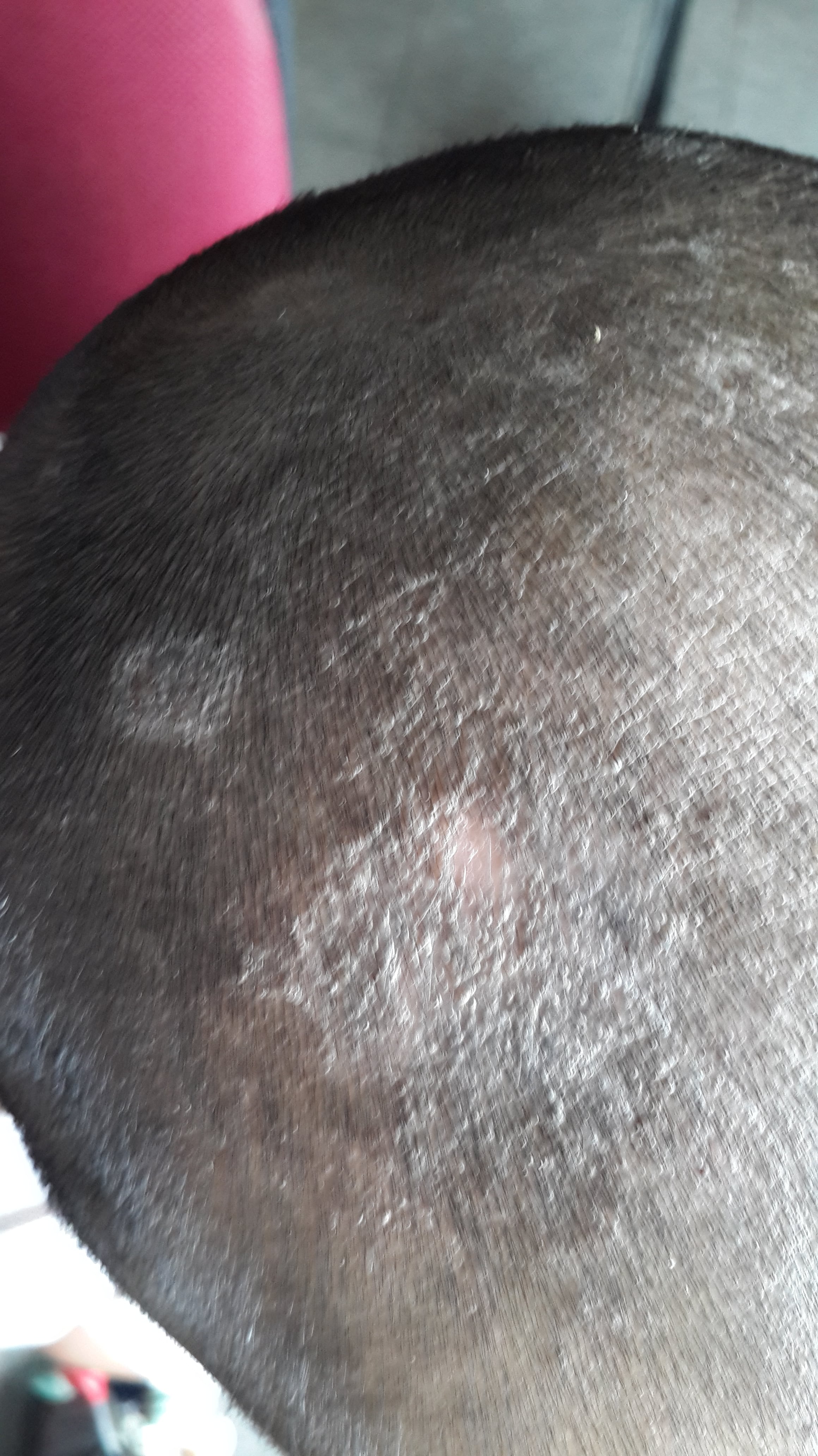 TIÑA SECA DE LA CABEZA