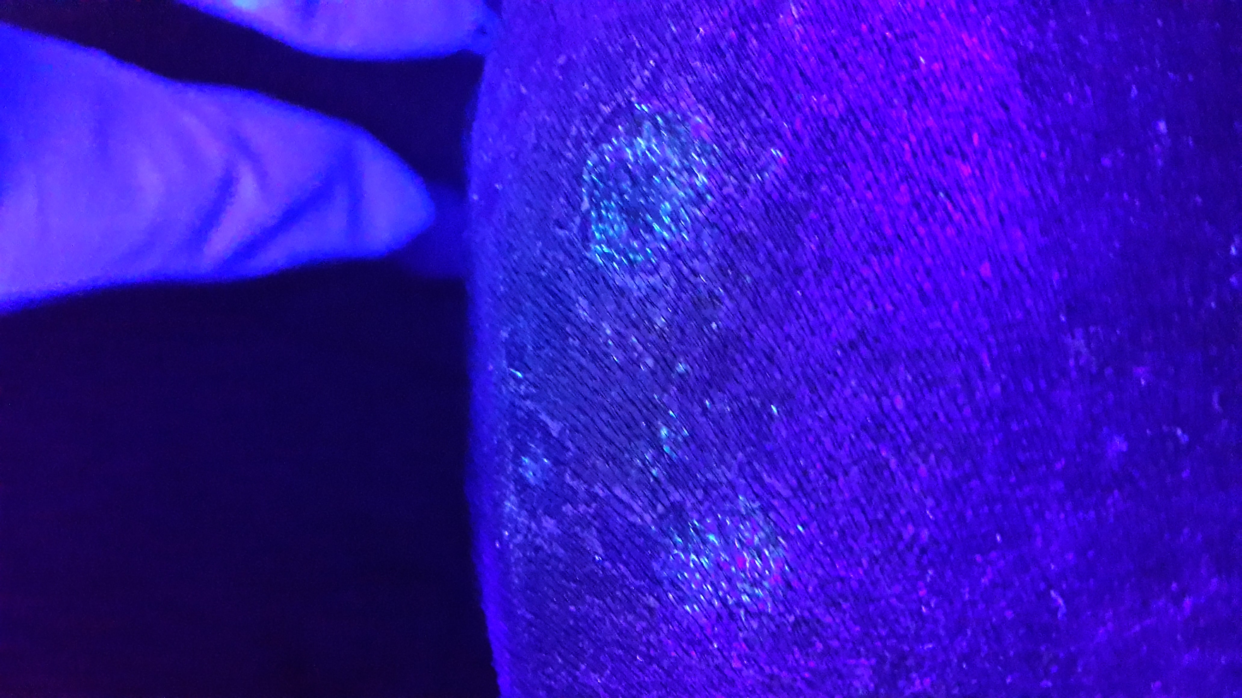 TIÑA MICROSPORICA - Luz de wood