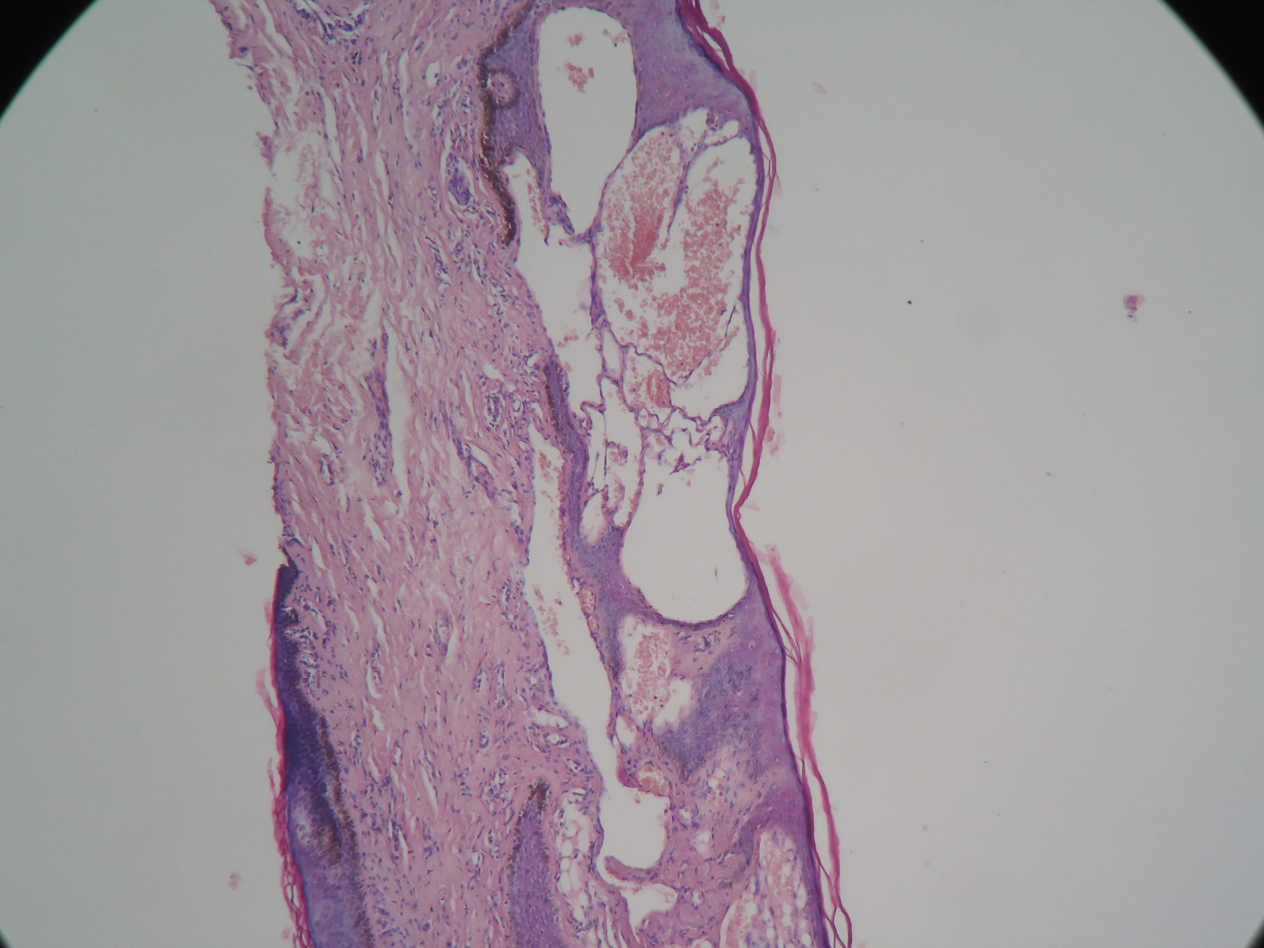HEMANGIOMA VULVAR - Histpopatologia