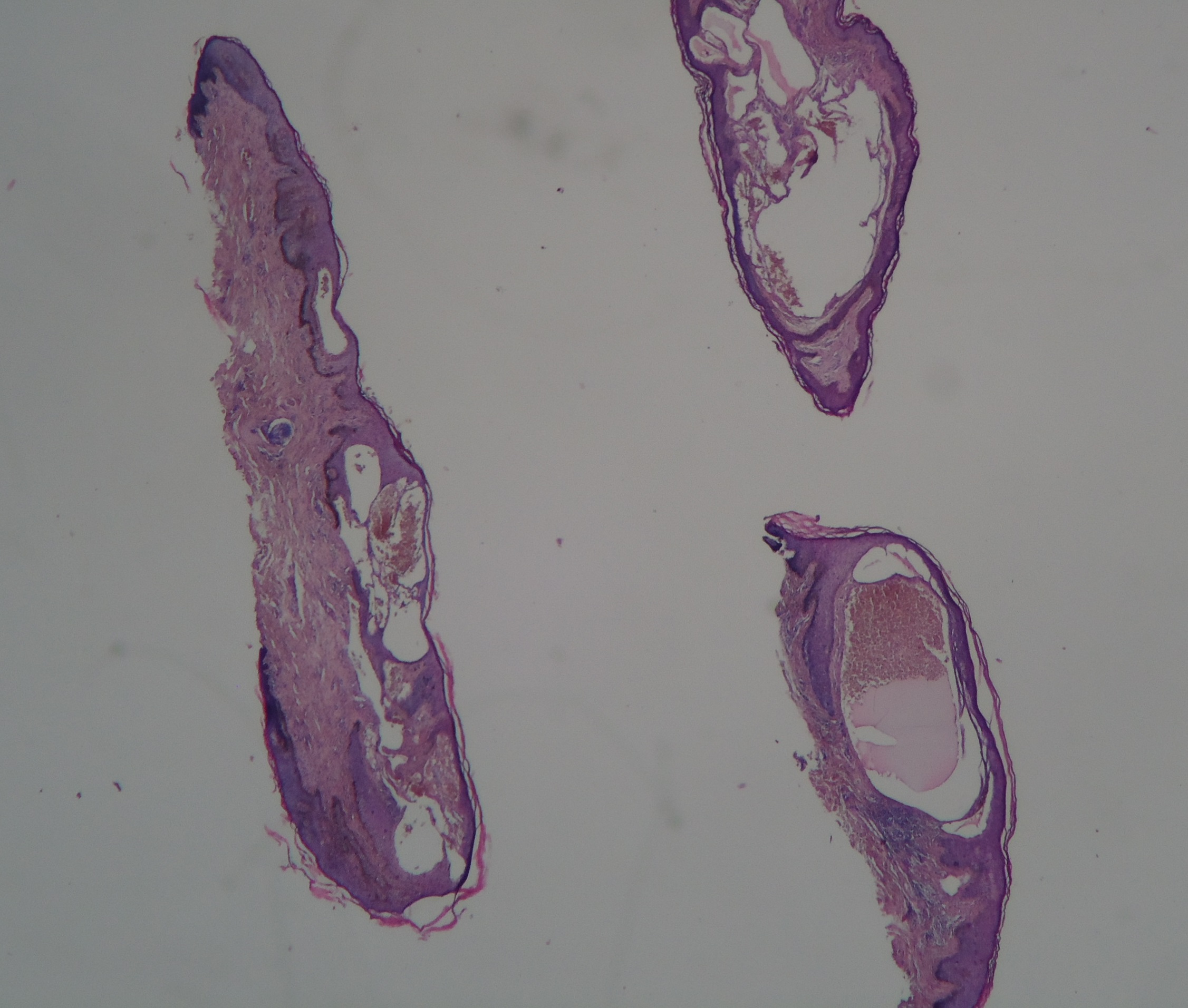 HEMANGIOMA VULVAR - Histpopatologia
