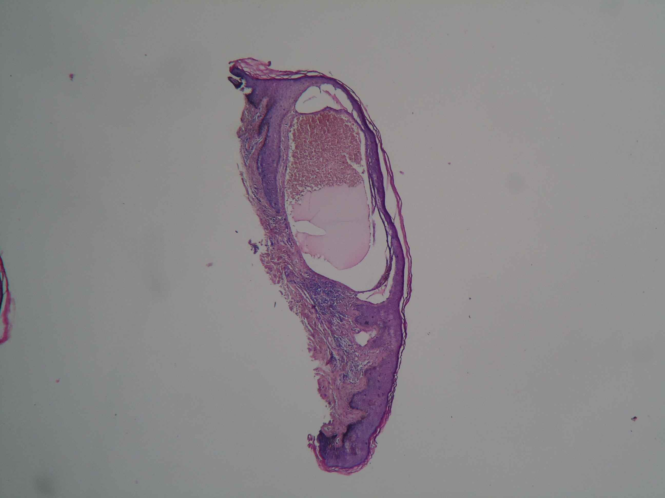 HEMANGIOMA VULVAR - Histpopatologia