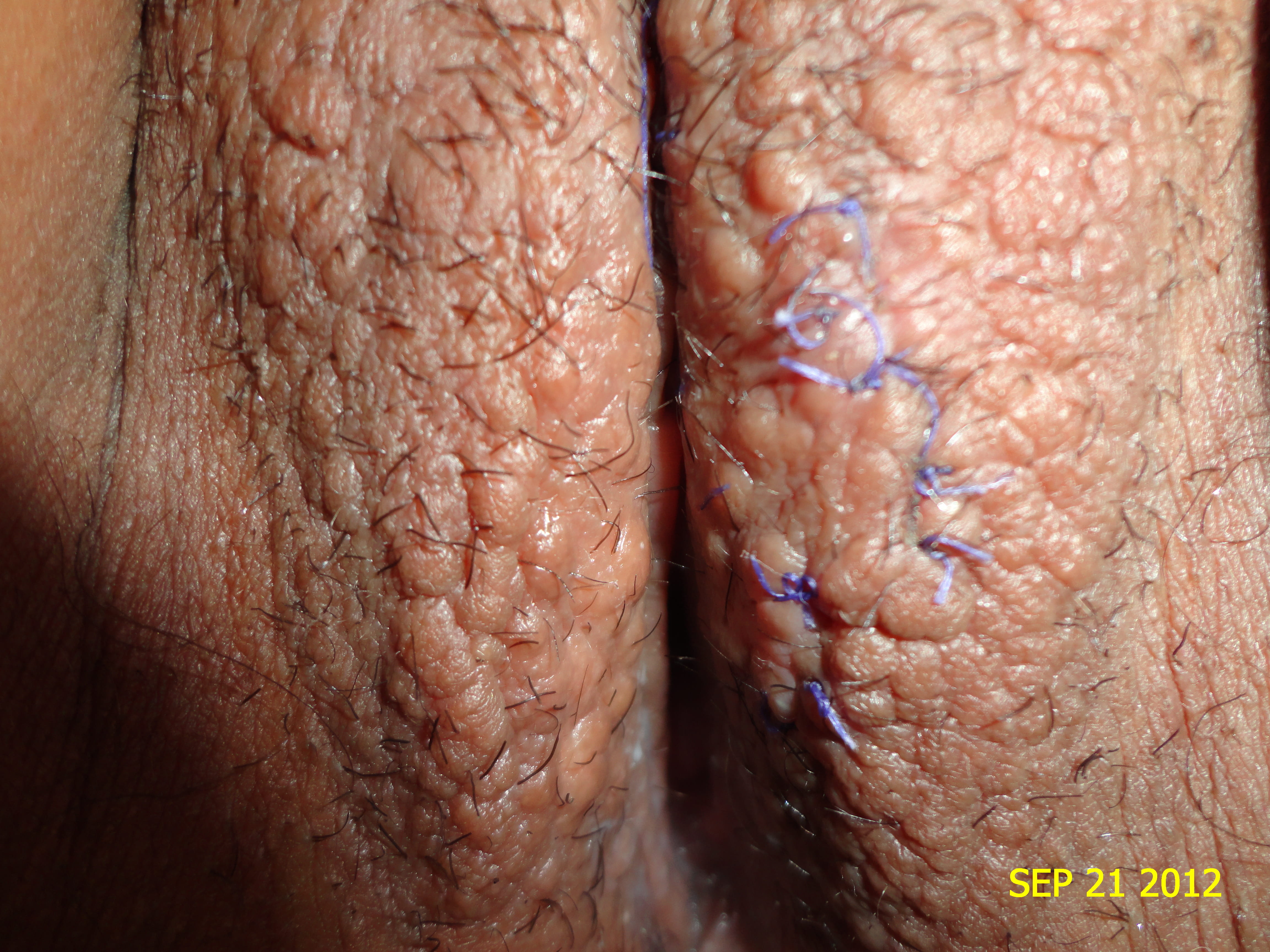 SIRINGOMAS DE LA VULVA