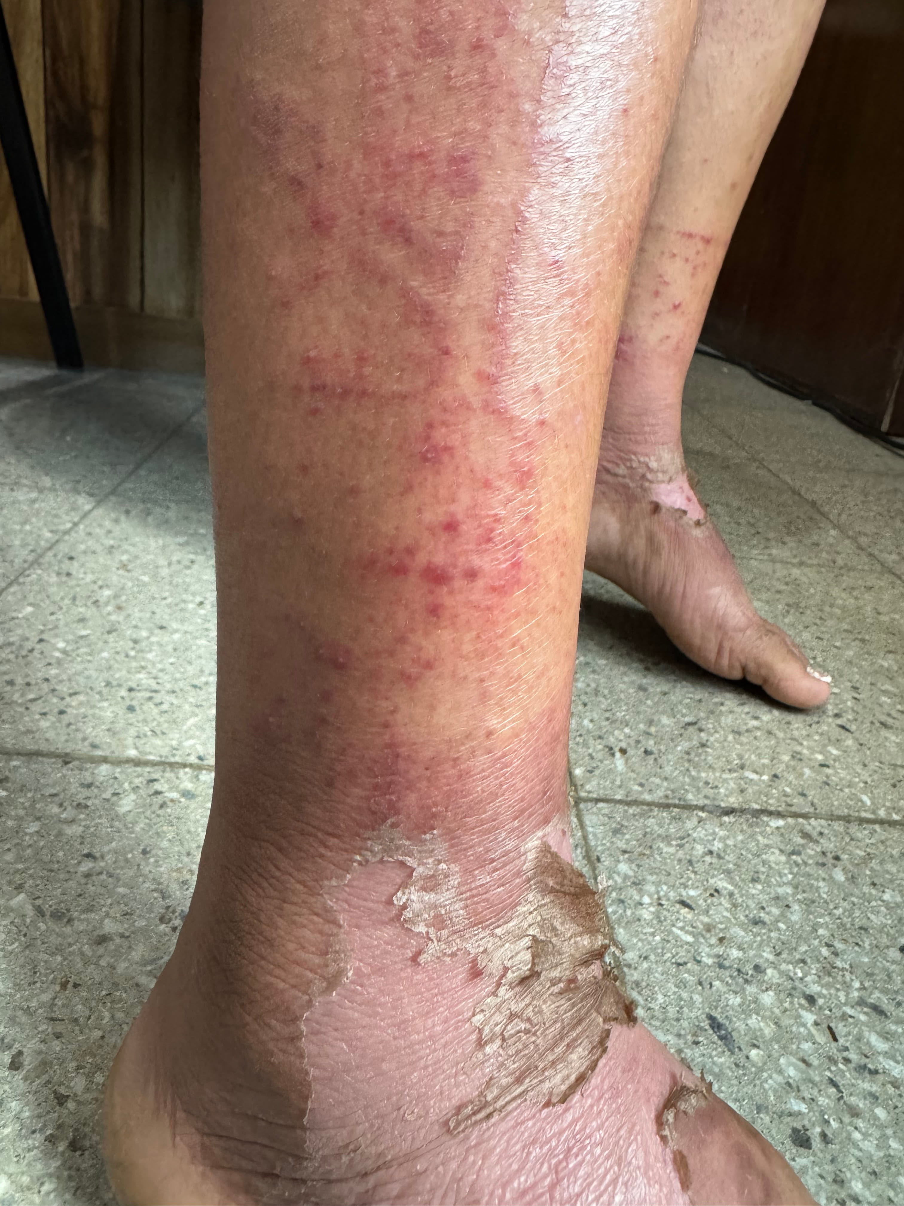 DERMATITIS POR CONTACTO - por botas de hule