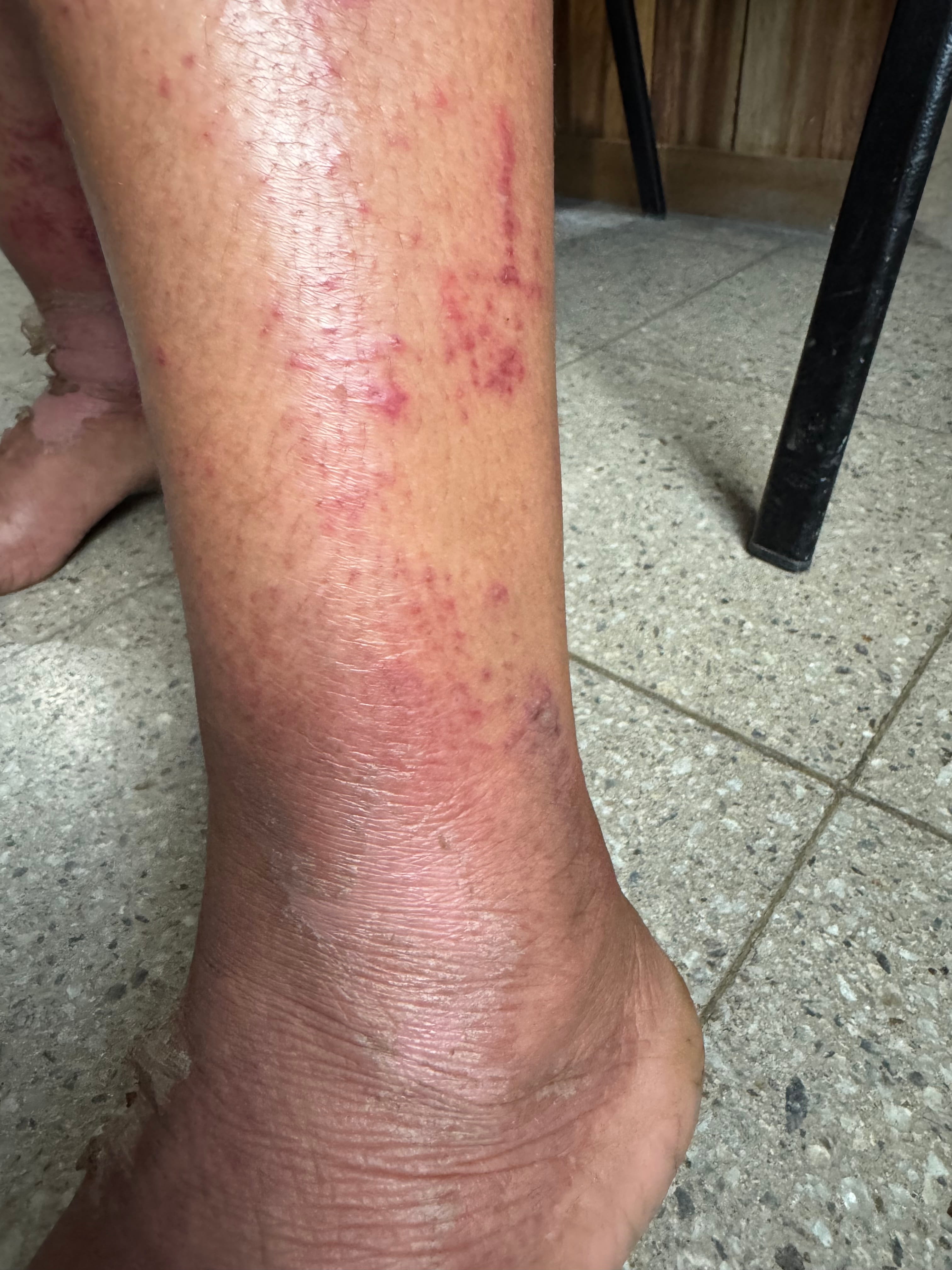 DERMATITIS POR CONTACTO - por botas de hule