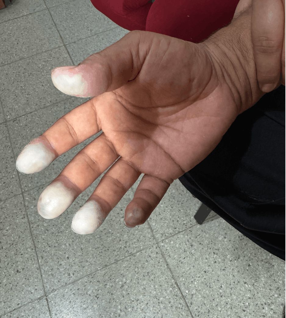 DERMATITIS POR CONTACTO - por acido clorhidricoñasle