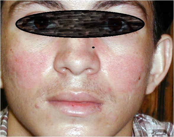 ERITEMA PPR ESTEROIDES TOPICOS