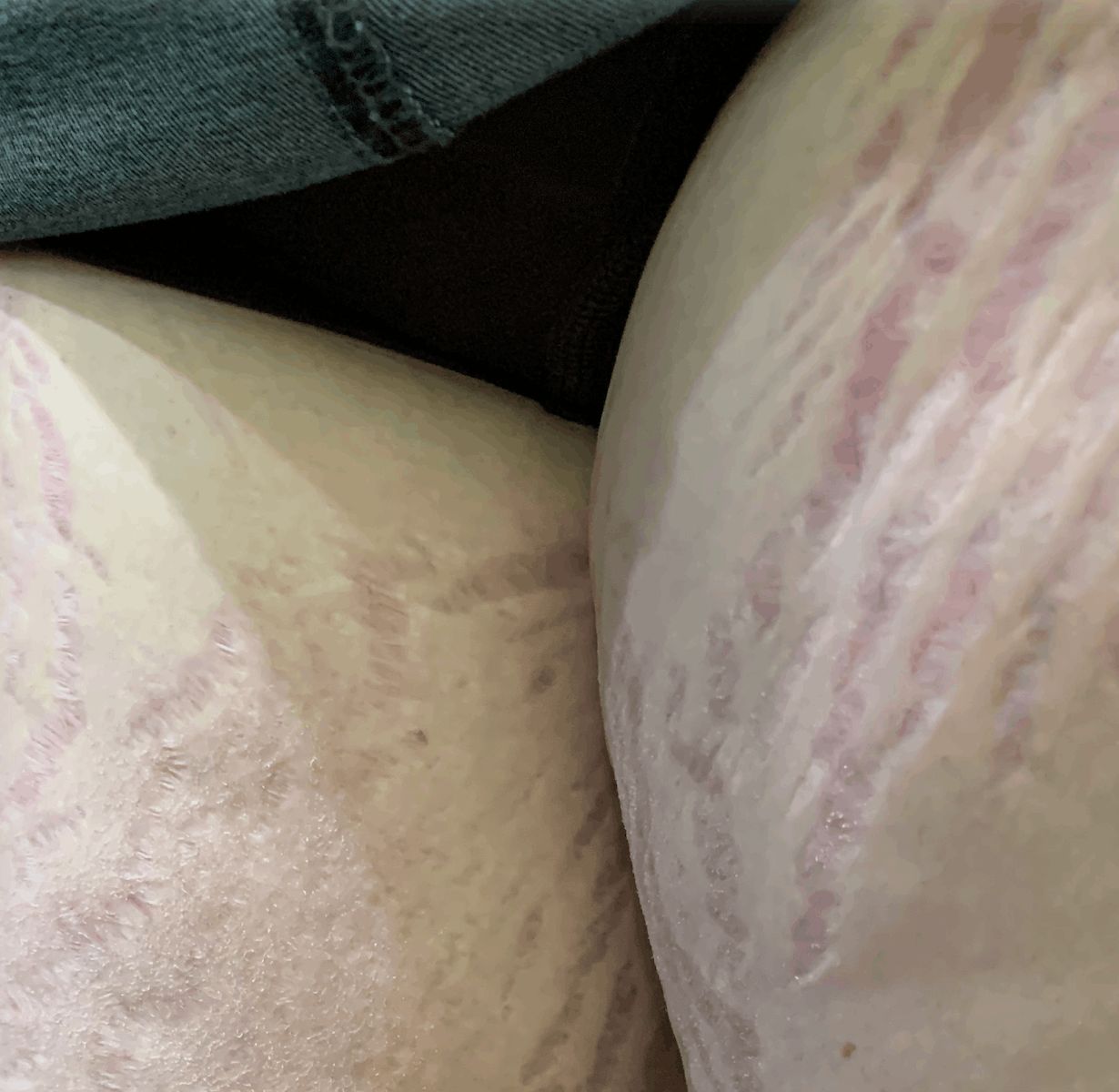 ESTRIAS ATROFICAS - por esteroides topicos