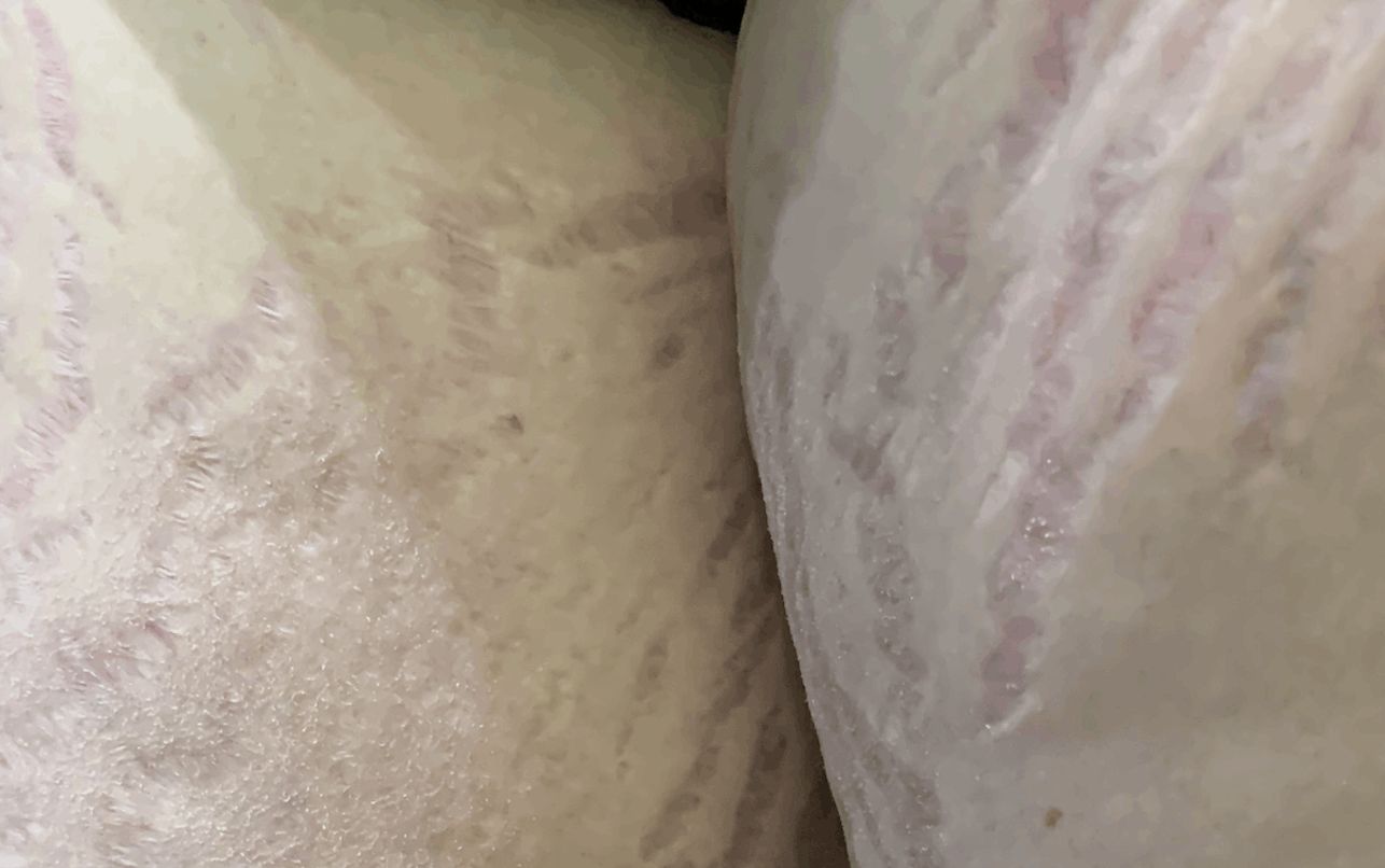 ESTRIAS ATROFICAS - por esteroides topicos