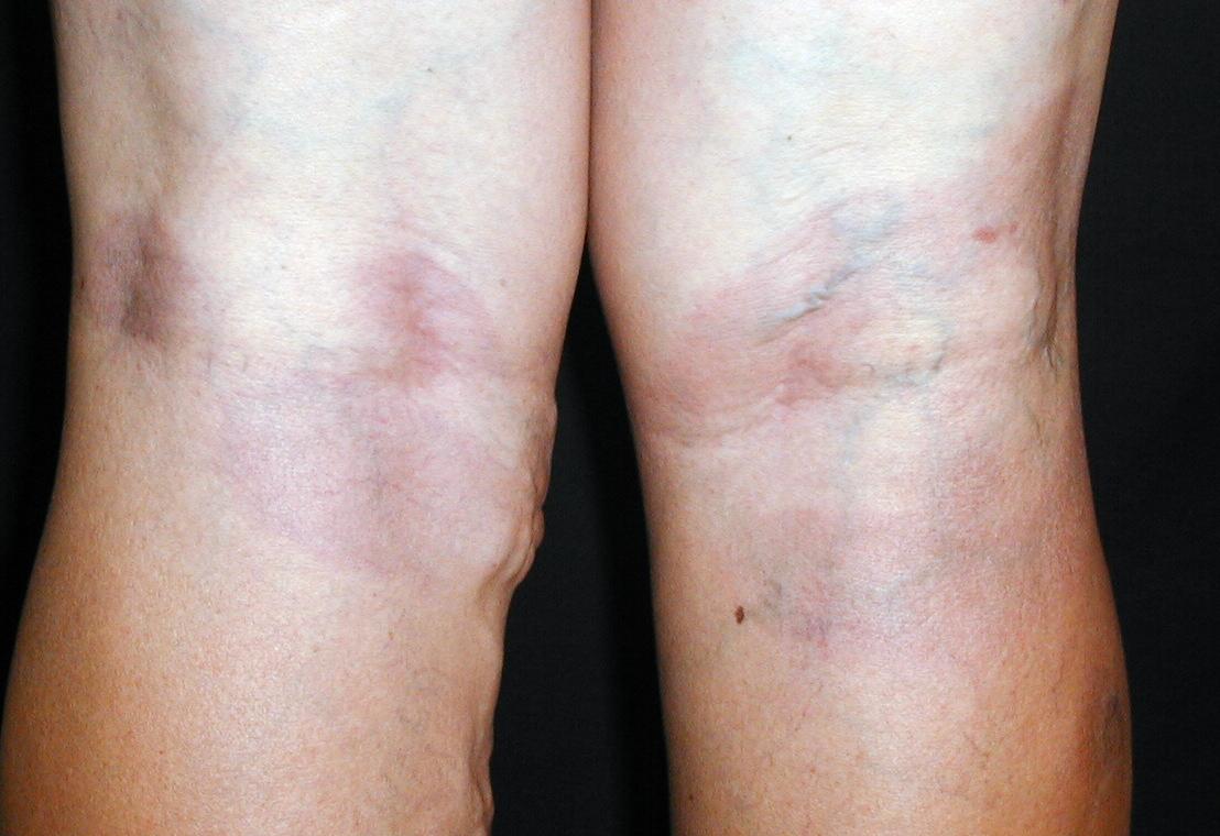 ERITEMA PIGMETADO FIJO - por Piroxicam