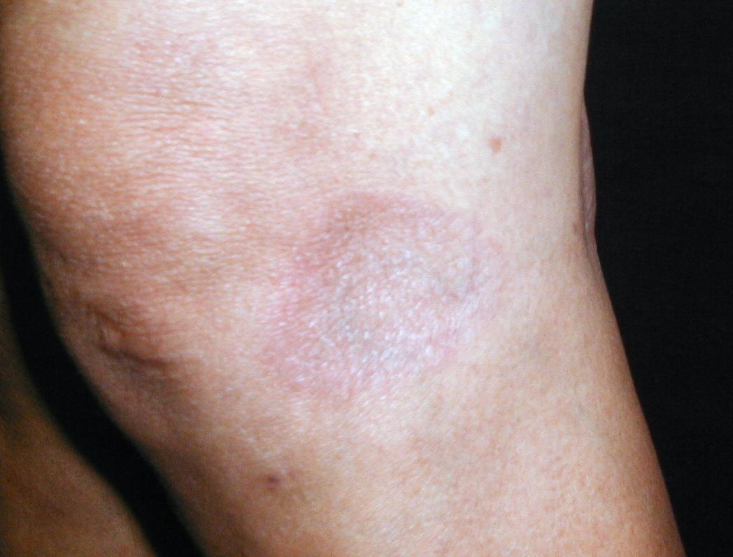 ERITEMA PIGMETADO FIJO - por Piroxicam