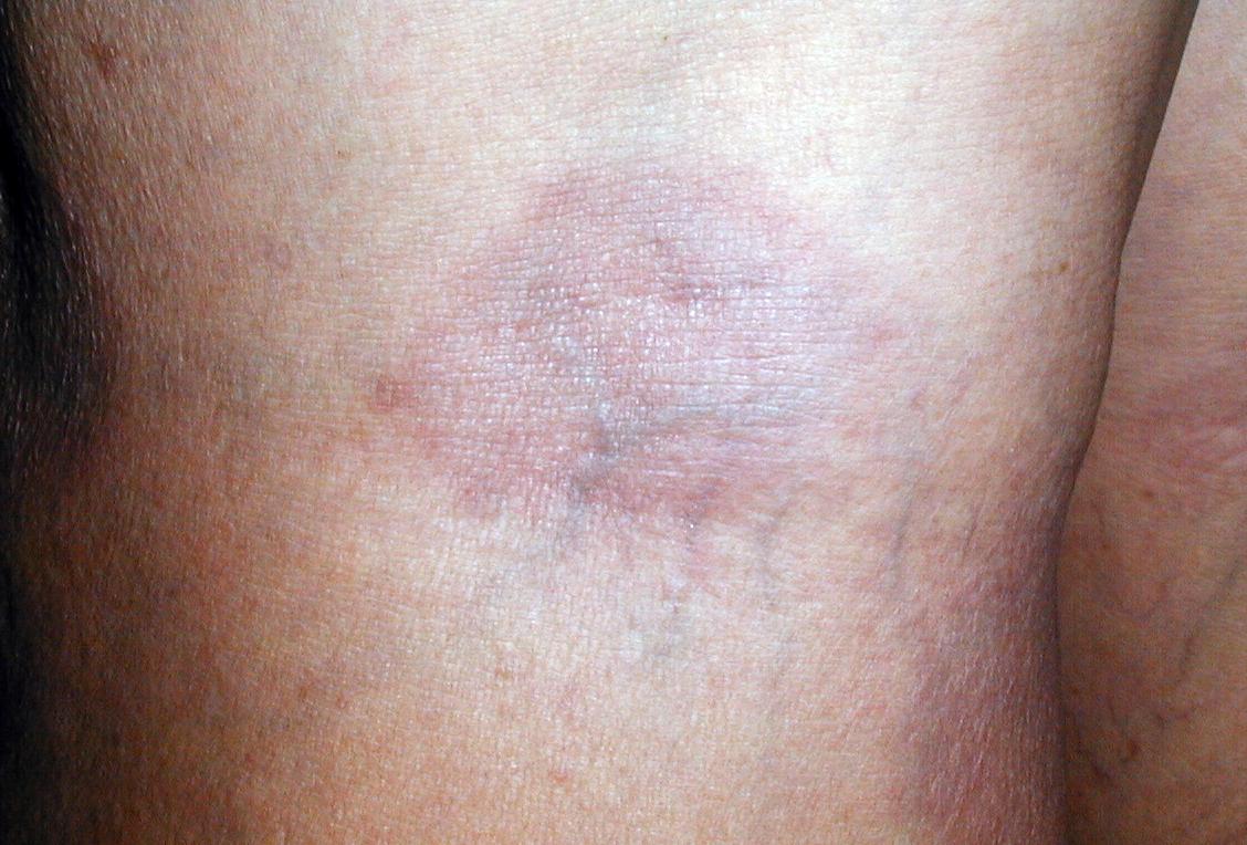 ERITEMA PIGMETADO FIJO - por Piroxicam