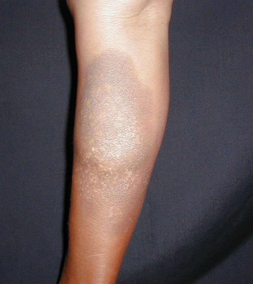 ERITEMA PIGMETADO FIJO - por sulfas