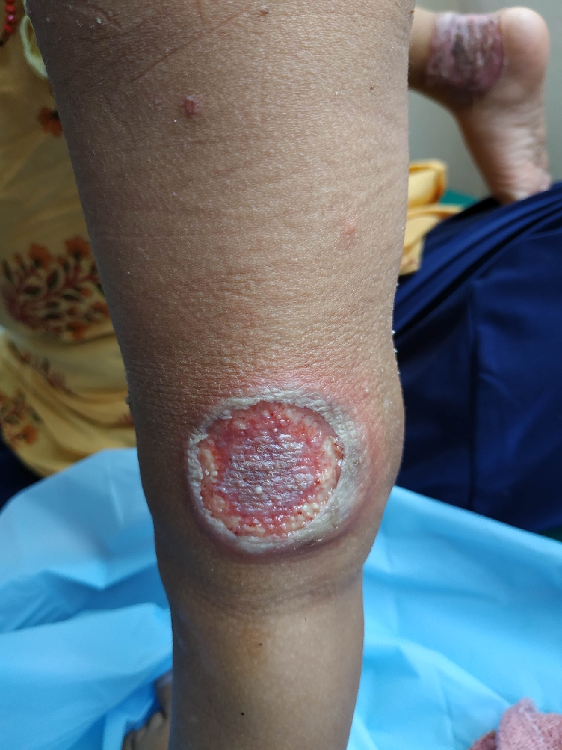PIODERMA GANGRENOSO
