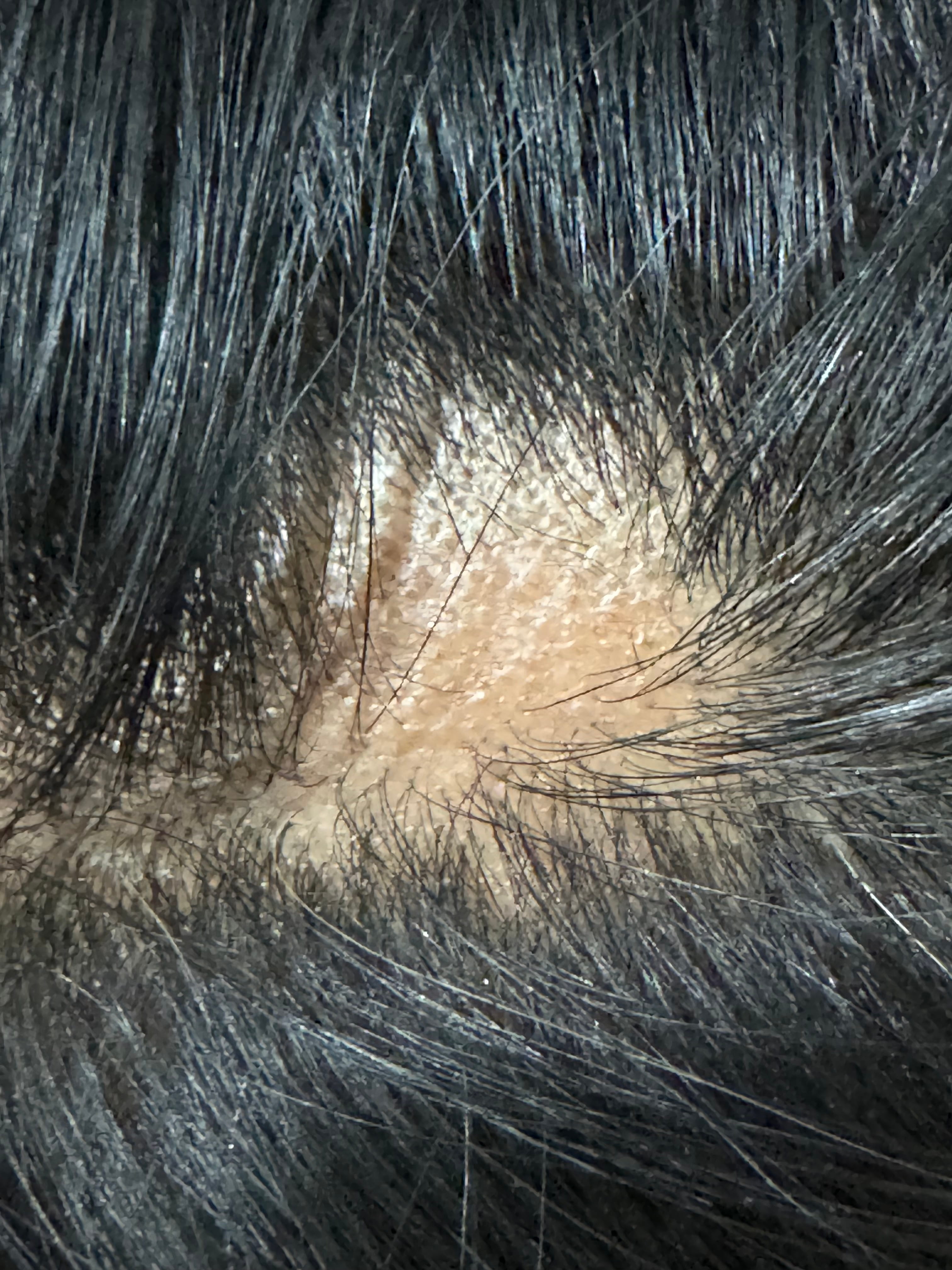 ALOPECIA AREATA