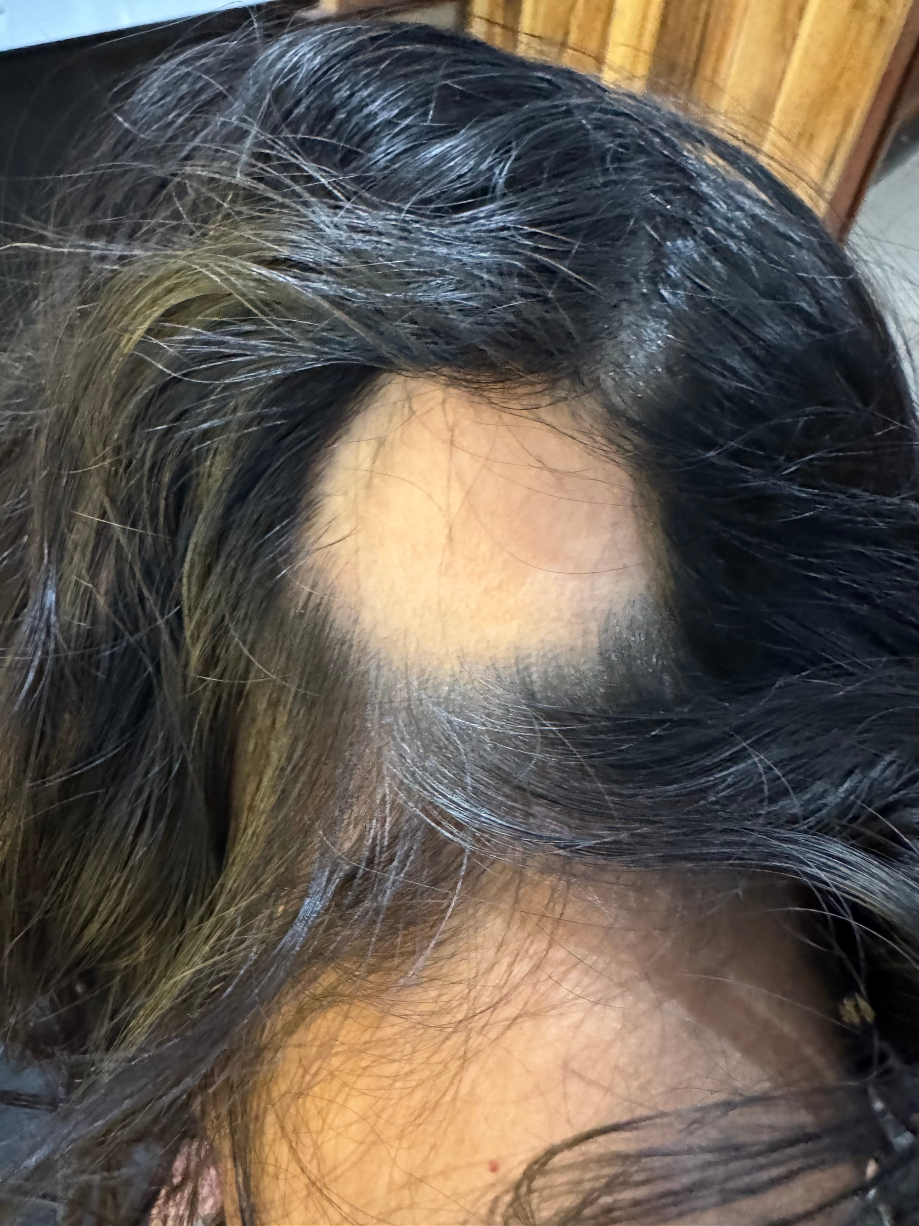 ALOPECIA AREATA
