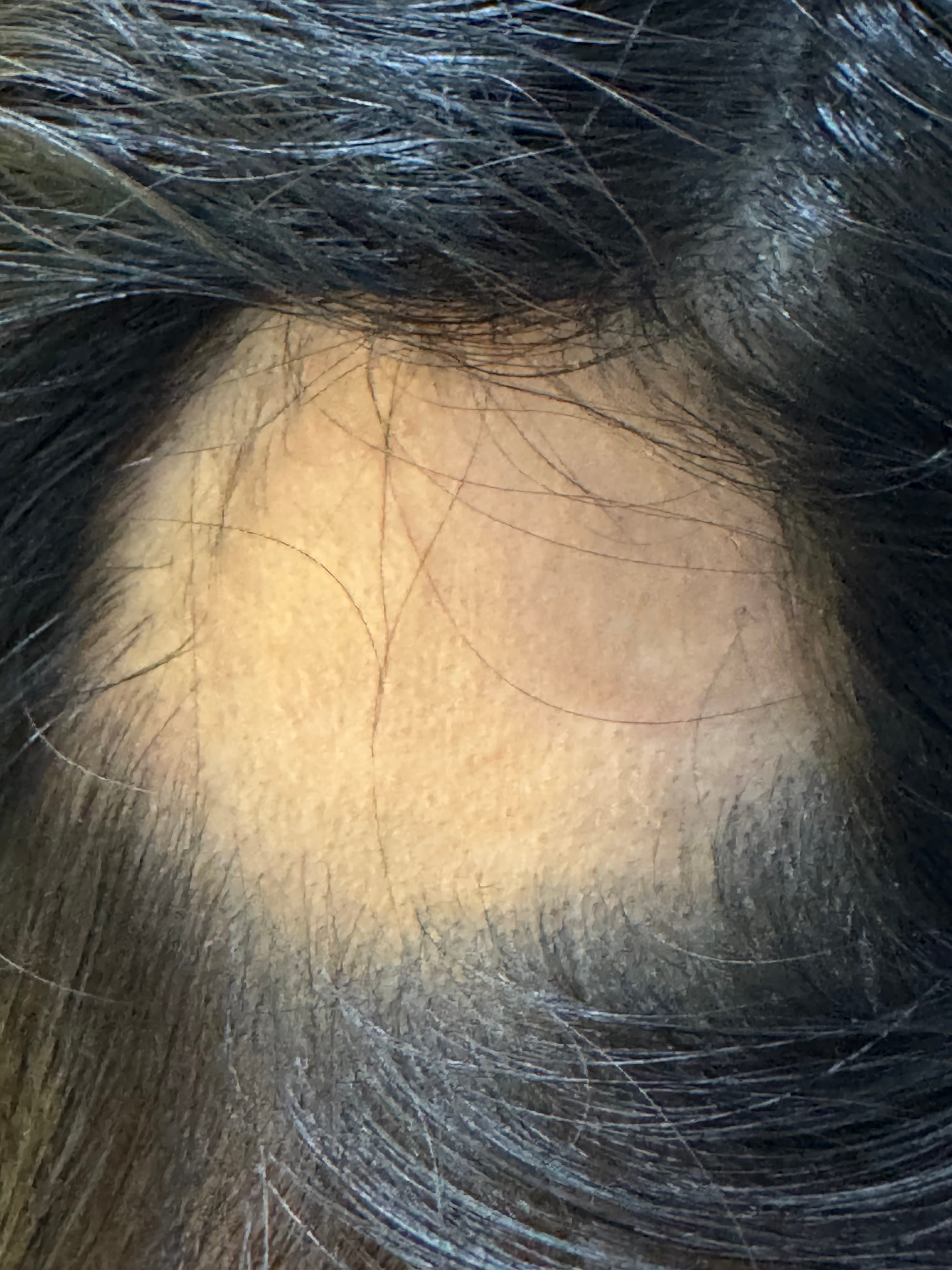 ALOPECIA AREATA