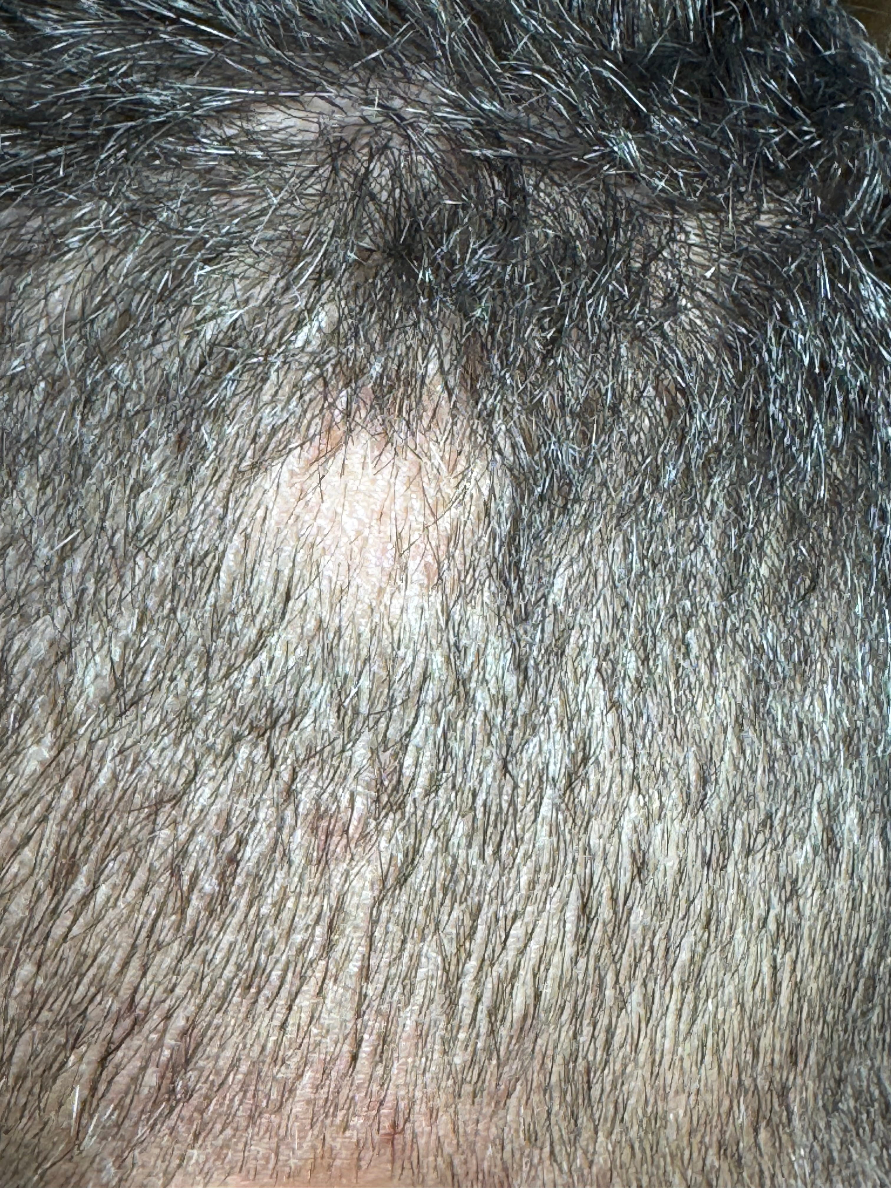 ALOPECIA AREATA