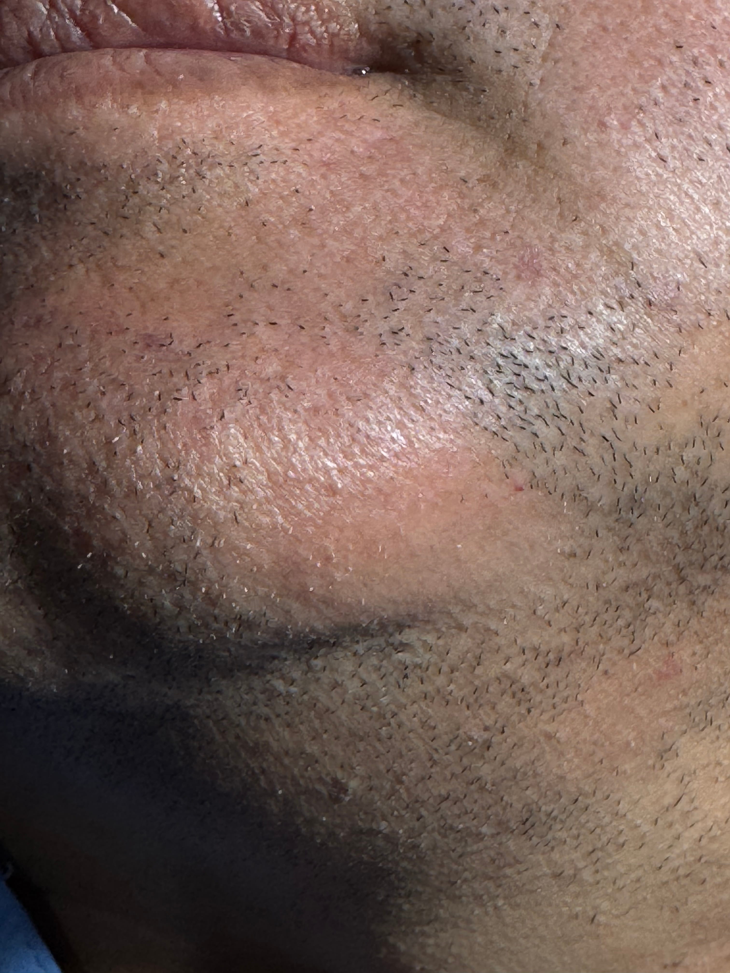 ALOPECIA AREATA del mentón