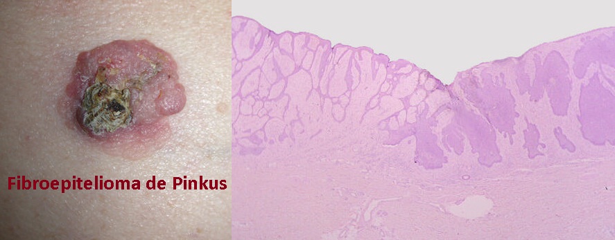 FIBROEPITELIOMA DE PINKUS