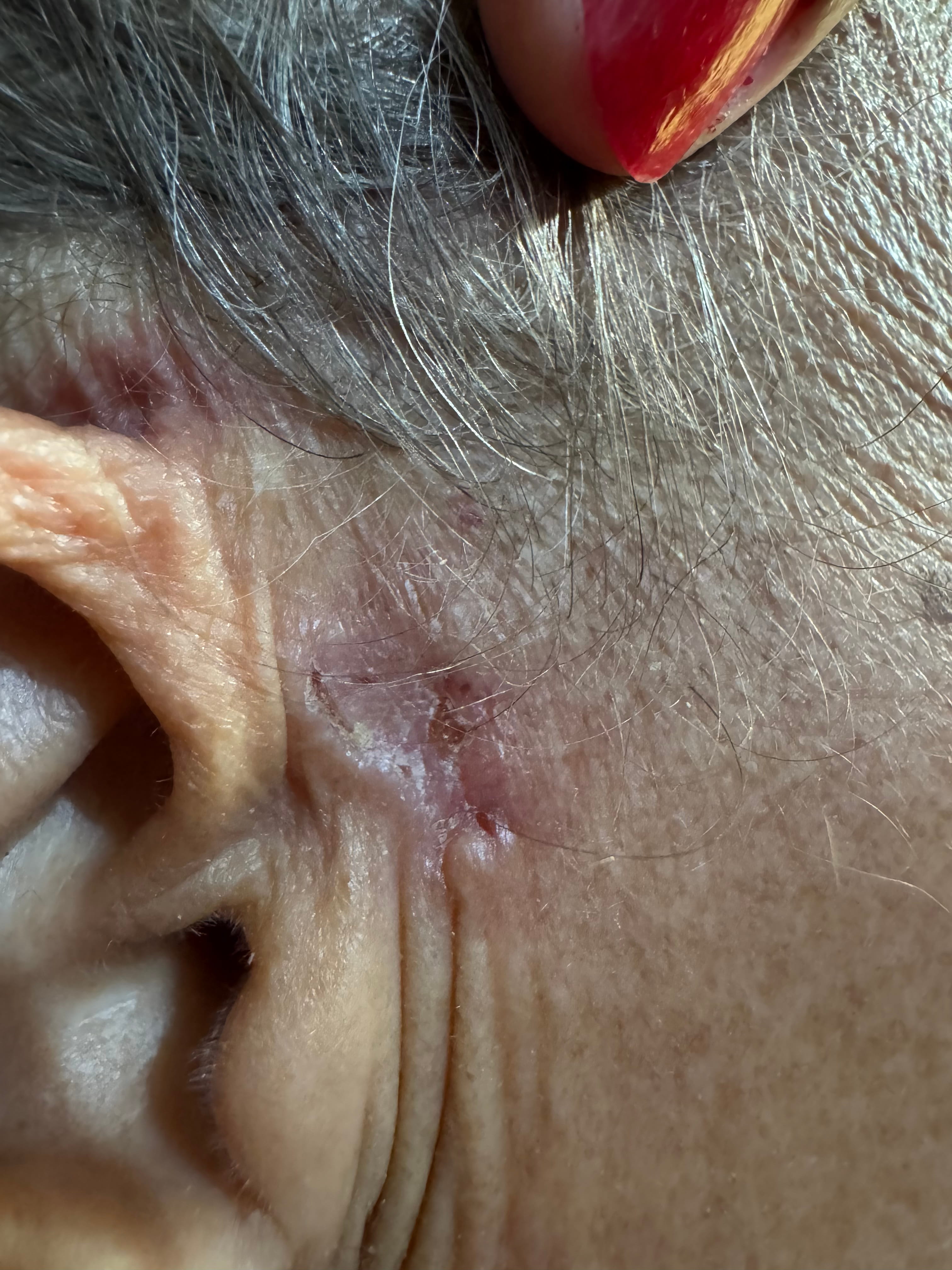 CANICIE Y CARCINOMA BASOCELULAR