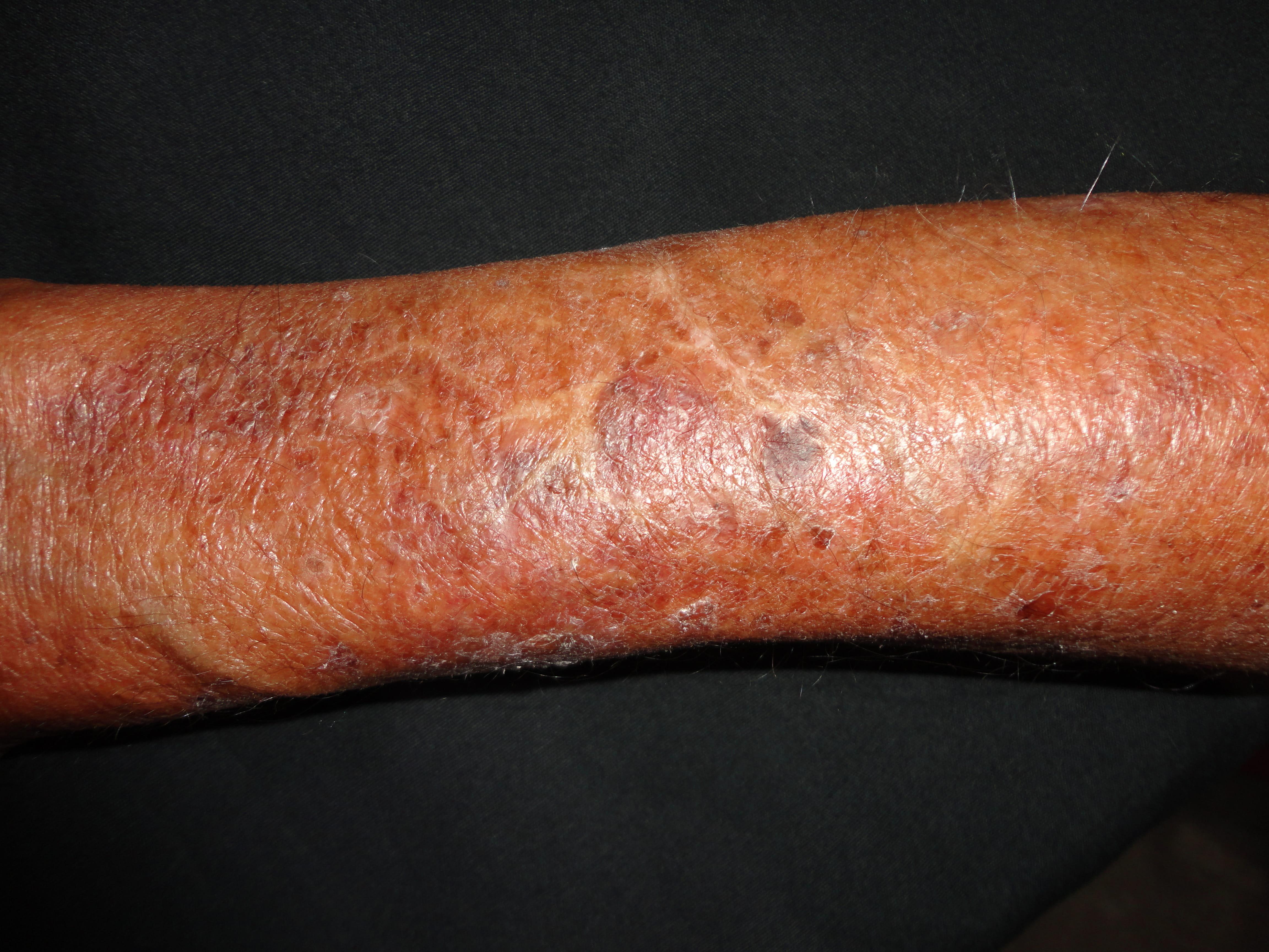 ATROFIA CUTANEA Y XEROSIS