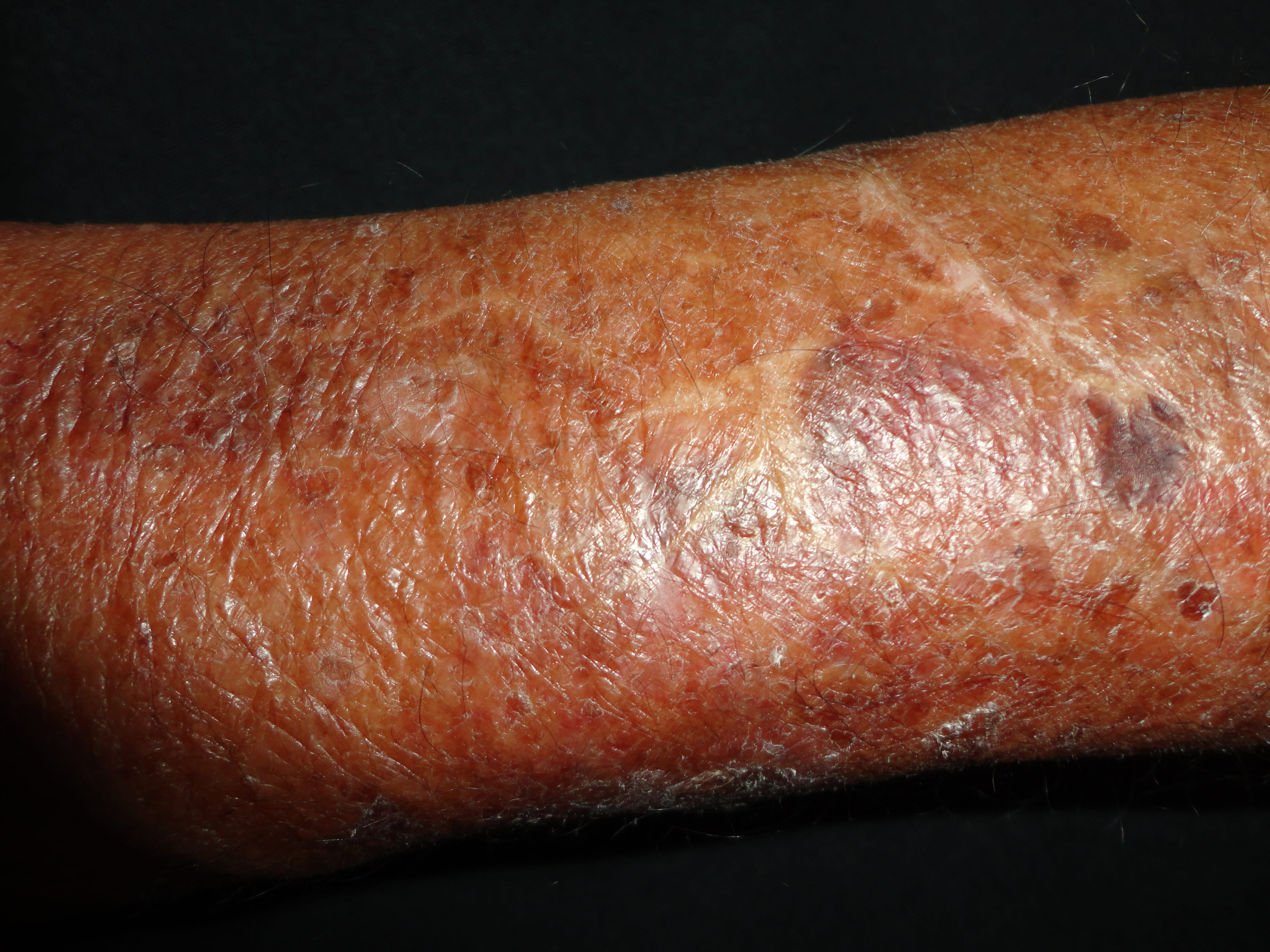 ATROFIA CUTANEA Y XEROSIS
