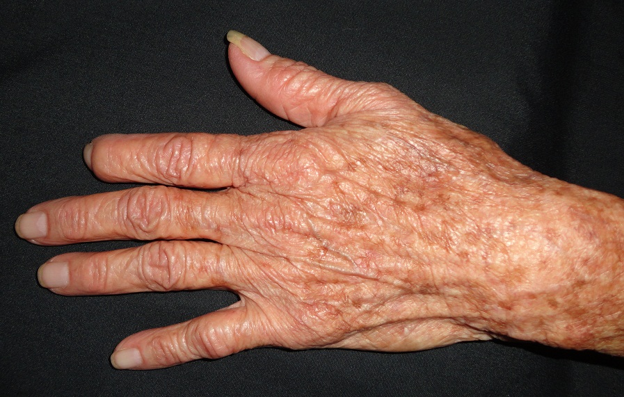 ATROFIA CUTANEA