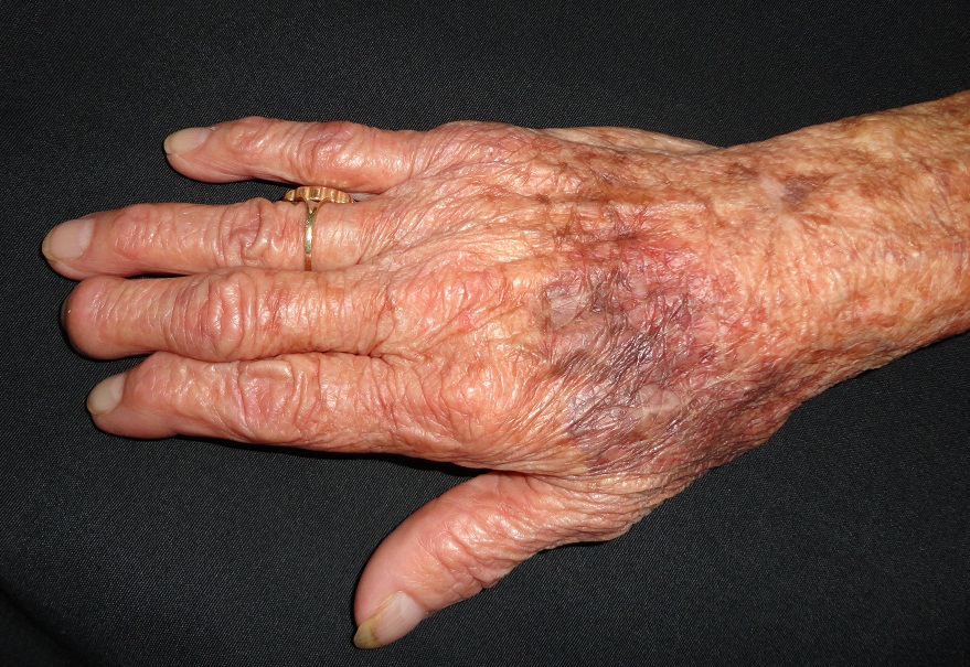 ATROFIA CUTANEA Y PURPURA