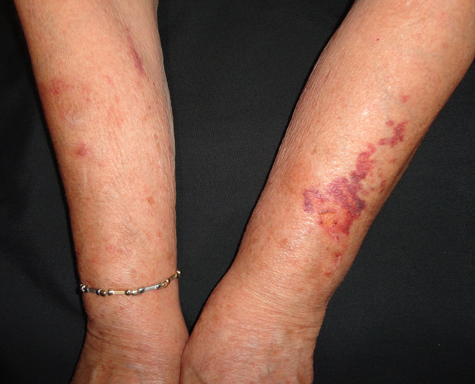 PURPURA SENIL