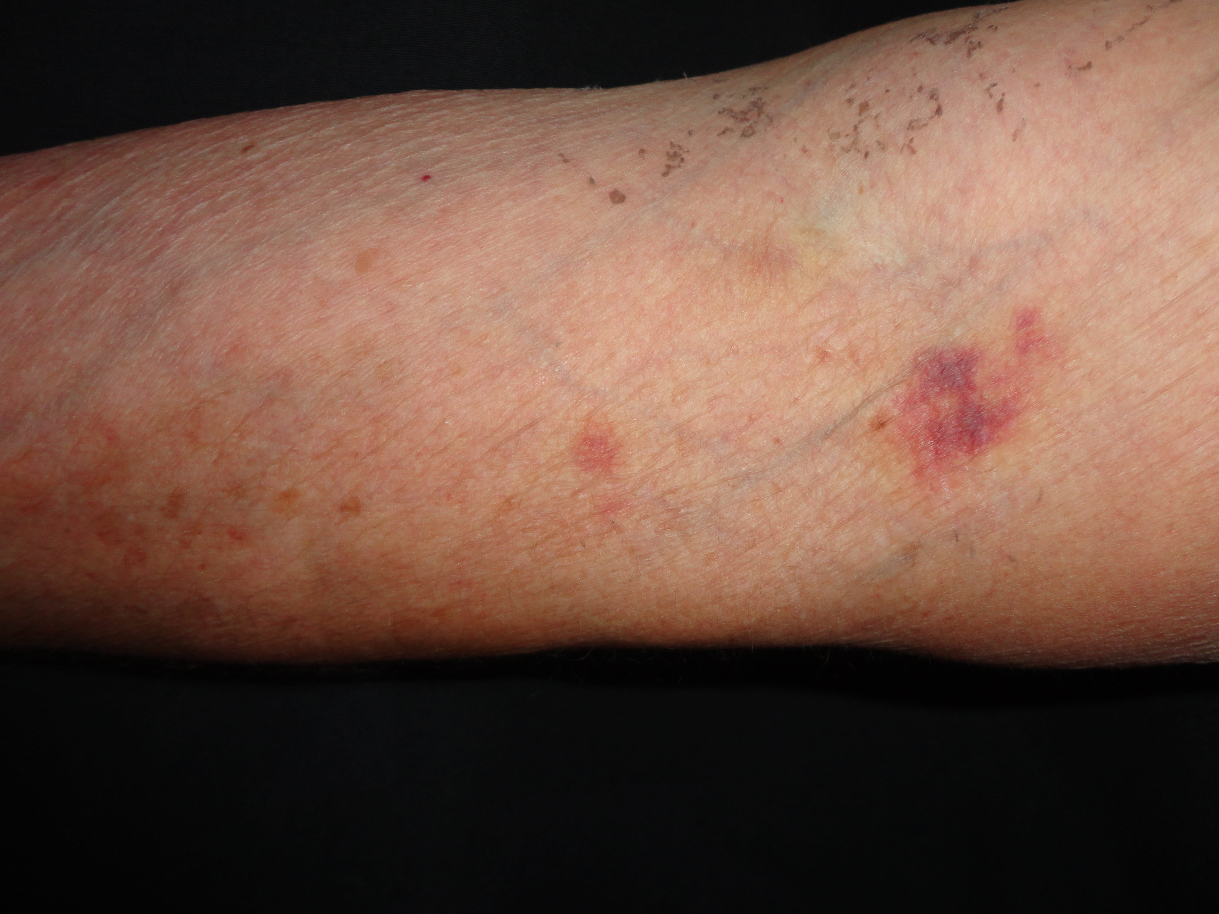 PURPURA SENIL