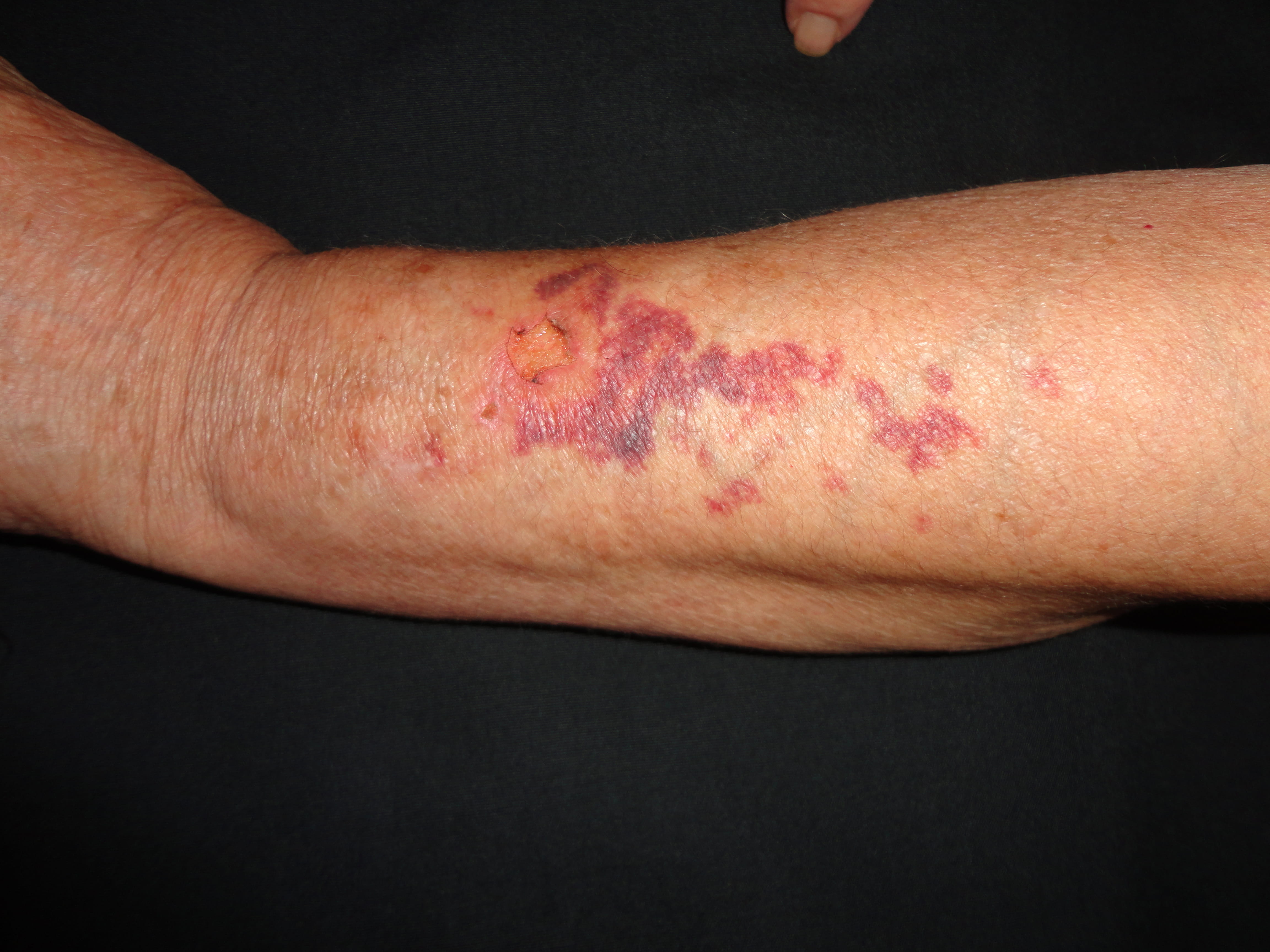 PURPURA SENIL