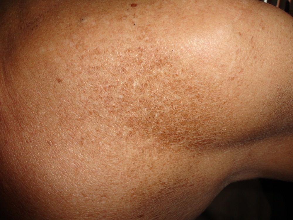 XEROSIS
