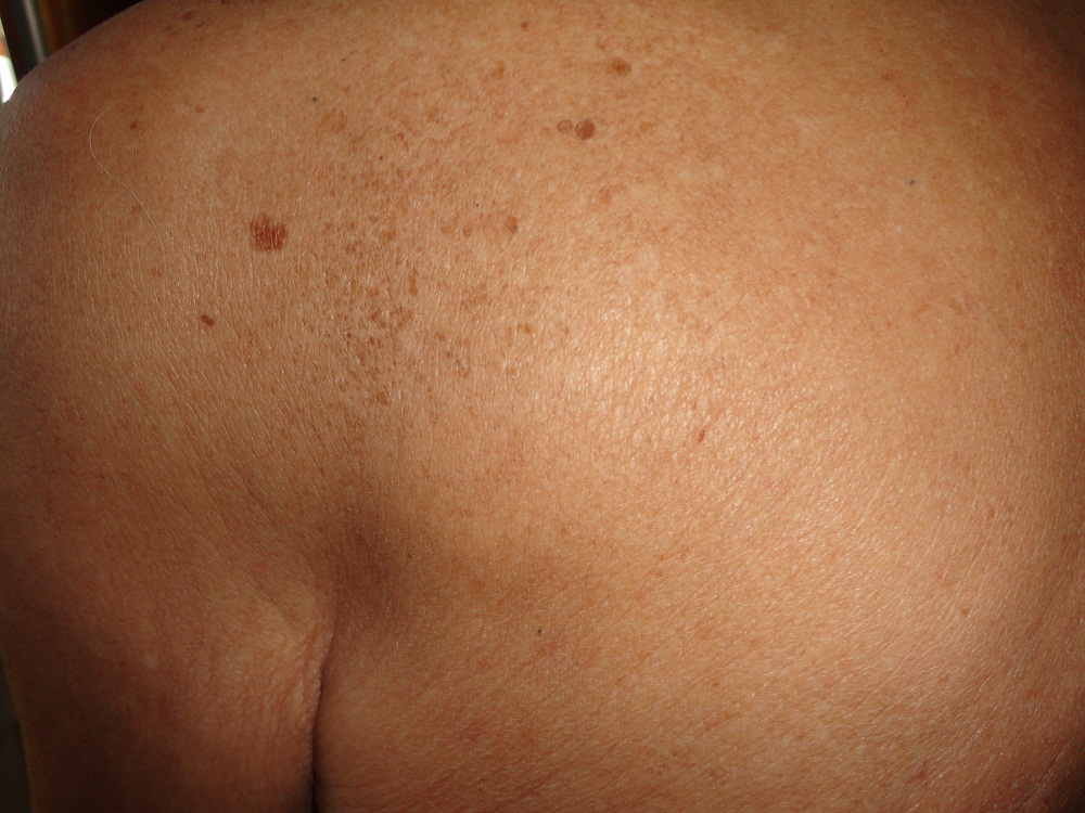 XEROSIS
