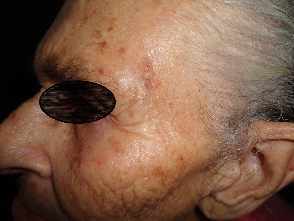 QUERATOSIS ACTINICAS - Fotoenvejecimiento