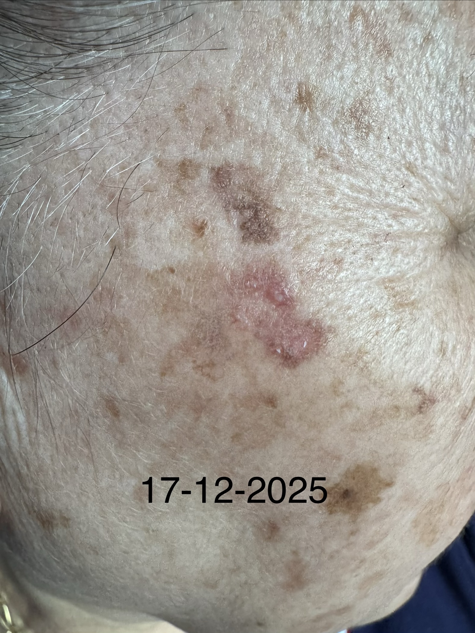 QUERATOSIS ACTINICAS - Fotoenvejecimiento