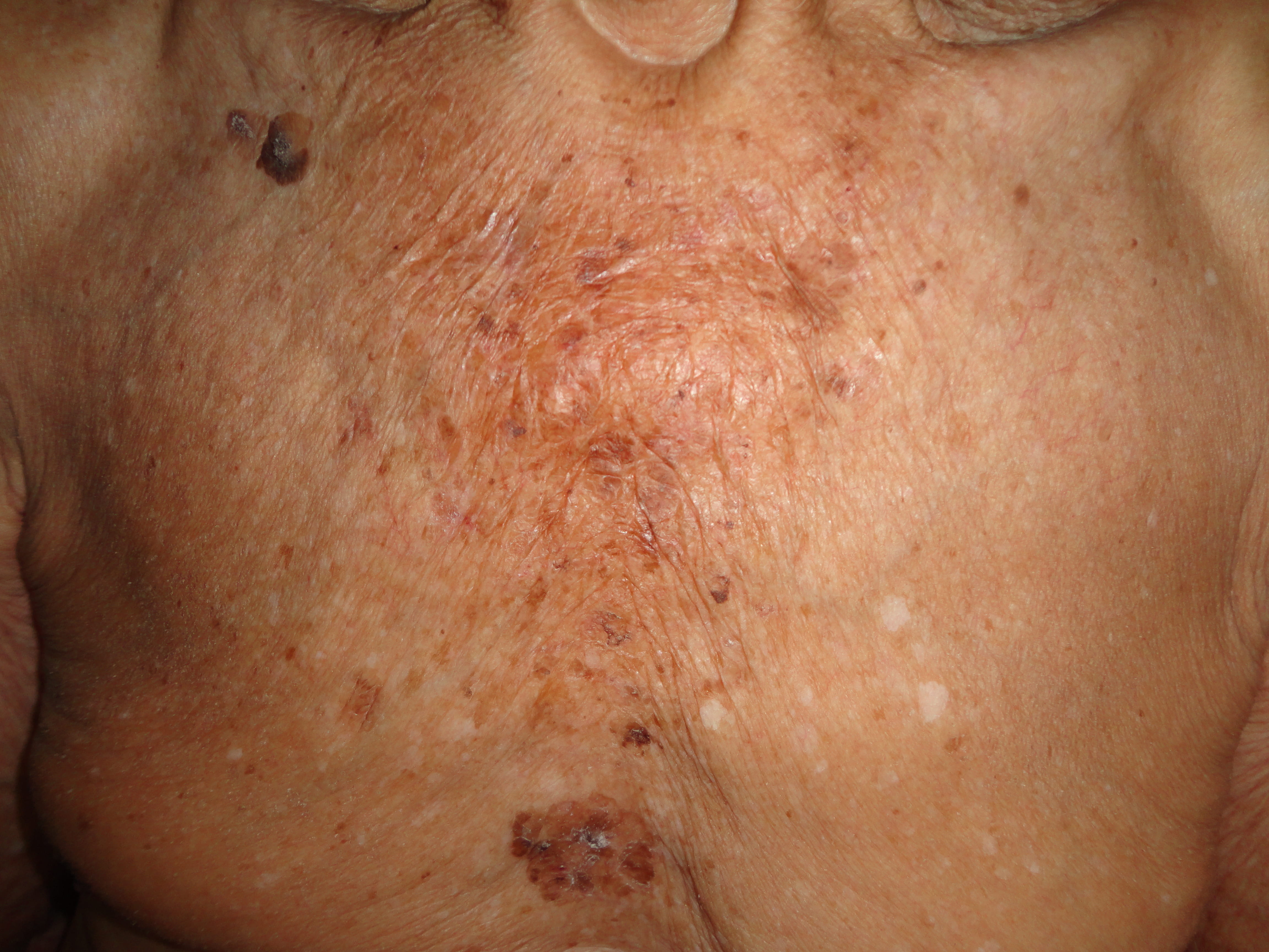 PURPURA - ATROFIA - PURPURA