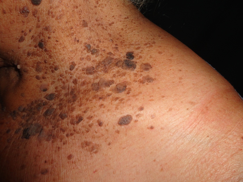 QUERATOSIS SEBORREICA